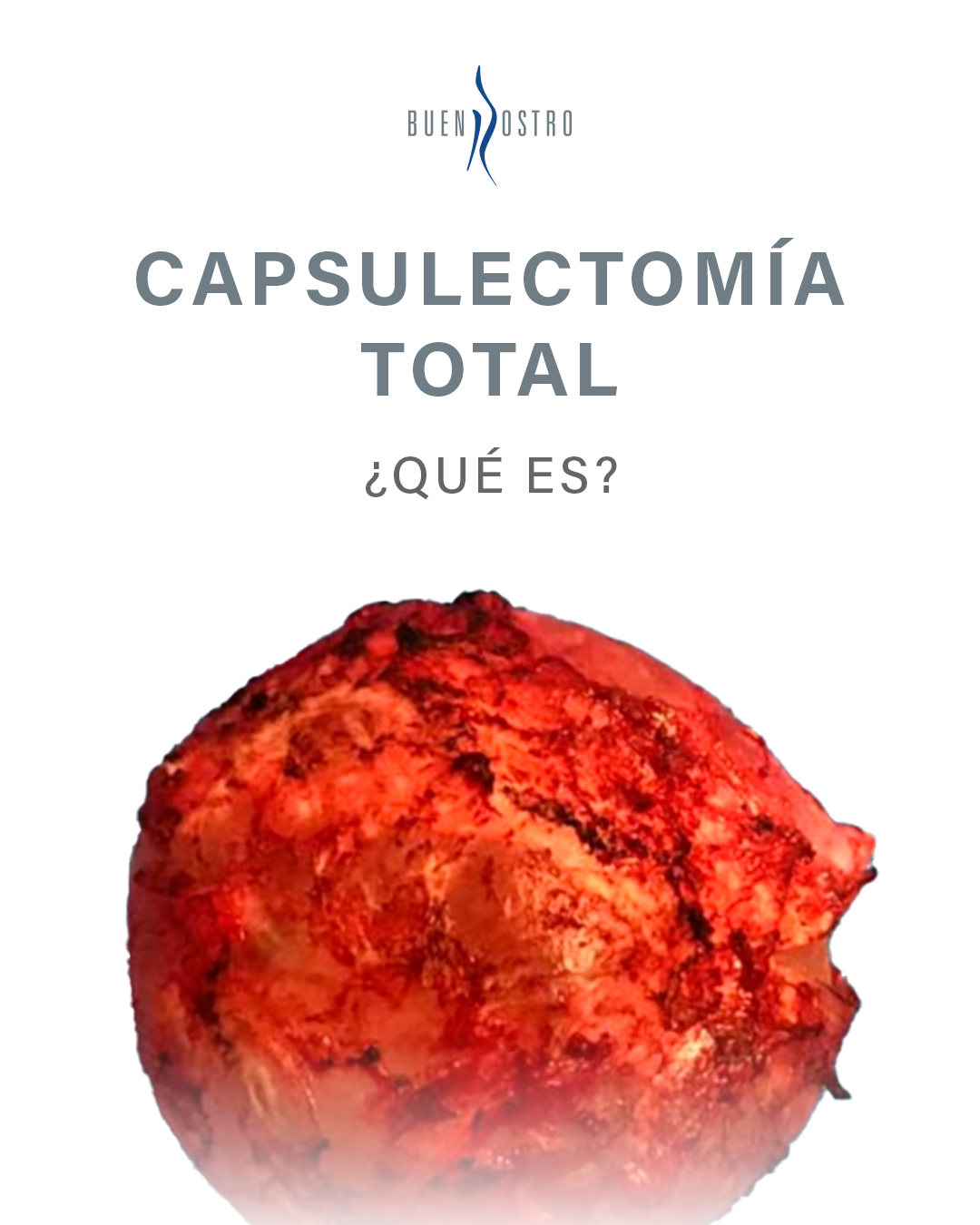 🩺 Capsulectomía total: ¿Cuándo se recomienda?
Si tienes implantes mamarios, esto puede interesarte.
Es de vital importancia el retiro de la cápsula para evitar problemas de salud a futuro.
