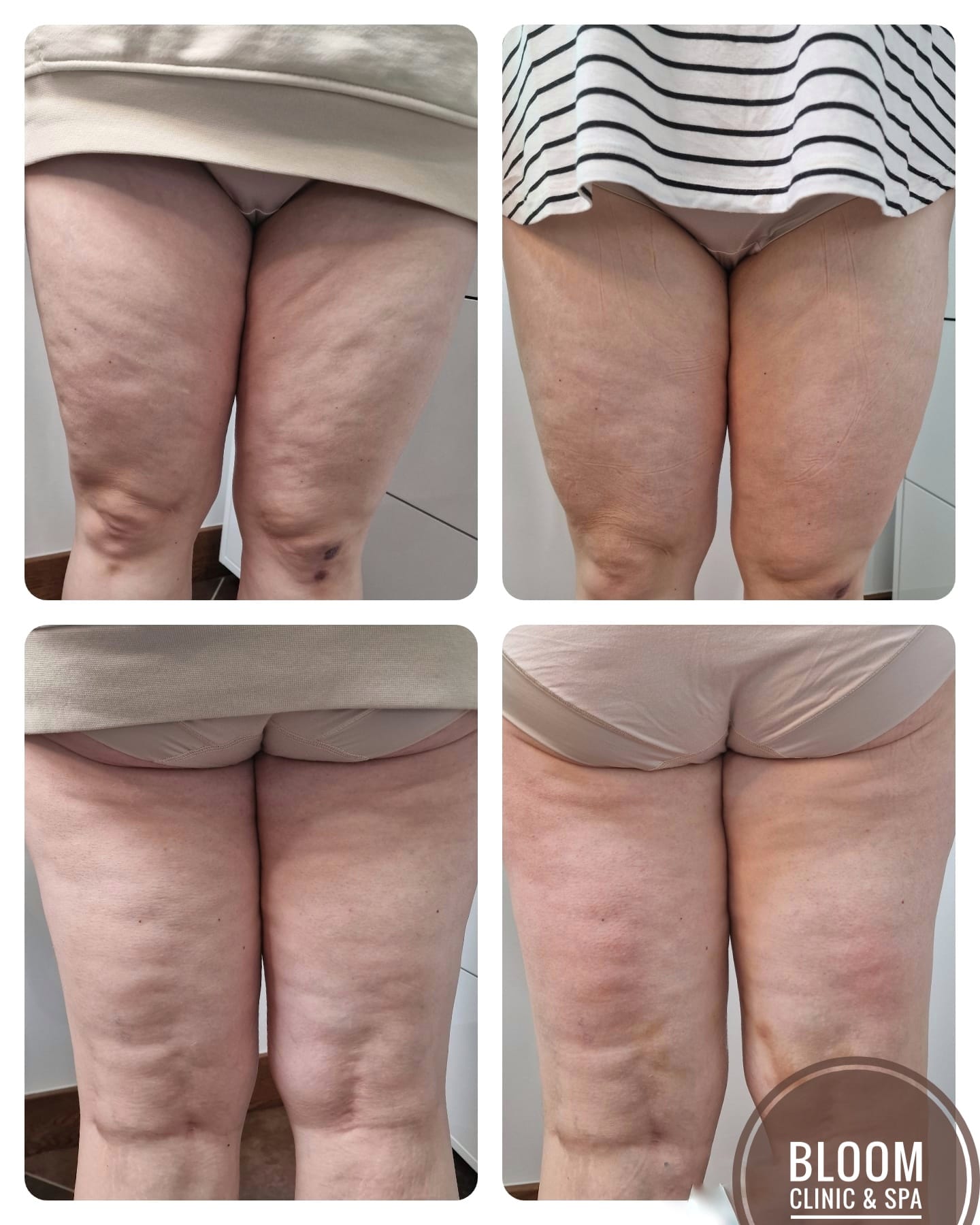 💥💥💥Body sculpting/ contouring
Combined therapy 2 hours💥💥💥
Ladies, we cordially invite you to our Bloom Clinic & SPA for an extraordinary pampering experience!
💥💥 Indulge in our Body Sculpting/Contouring combined therapy for 2 hours:
💥Pressotherapy
💥Arosha wrapping
💥Chinnese cupping
💥Ultrasonic cavitation
💥Dermomassager
Let us take care of your body and give you a true sense of renewal.
Save 20% on a package of 4 sessions! Normally £130 per session, but
‼️only £416 for 4 sessions ‼️
with our special offer!
💥Book your appointment today 07753262819 and feel the difference!💥💥