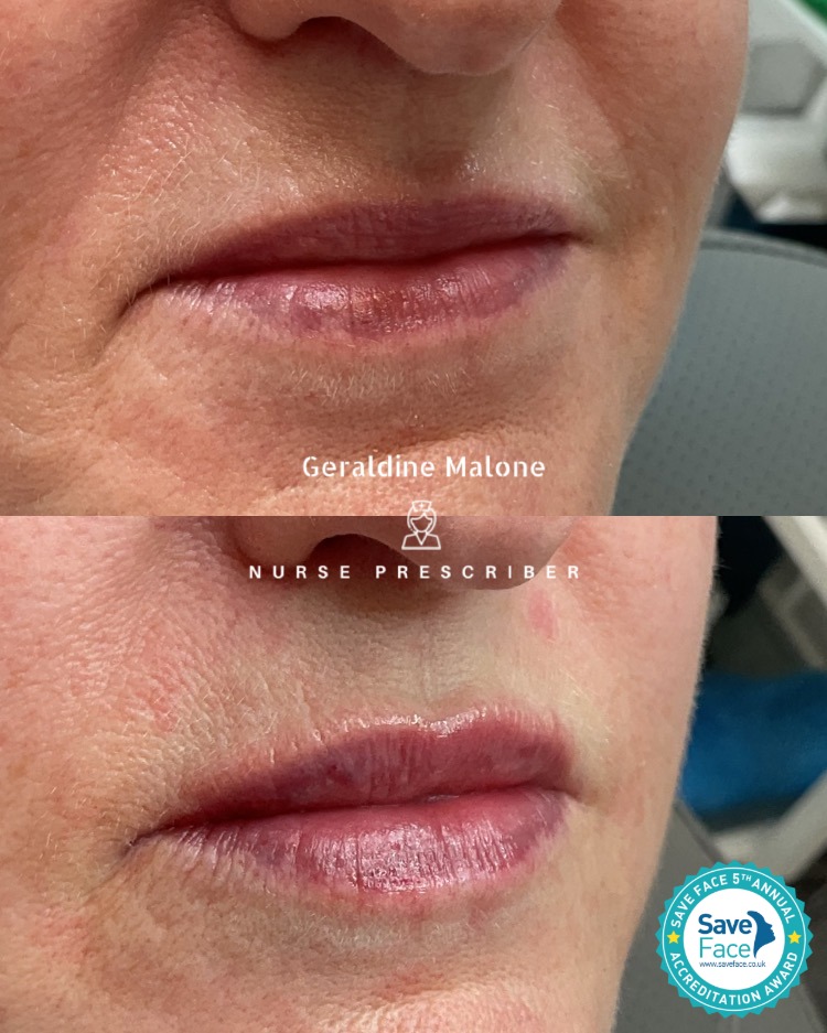 Lips Enhancement with 0.5ml Top Quality Dermal Filler
- Hydration and volume, whilst maintaining natural shape and proportion
- NO edited images
- Treatment price: 0.5ml/£145, 1ml/£225
- Recovery time: 24/48hrs
- Results lasting 6-12 months
- All treatments carried out by Nurse Prescriber Geraldine Malone in a Save Face Registered Clinic
Book Now via the link below:
https://www.geraldinemalone.co.uk/book-appointment
Contact Us:
📍CV6 1EB
☎️ 024 7792 1812
📧 geraldinemaloneaesthetics@outlook.com