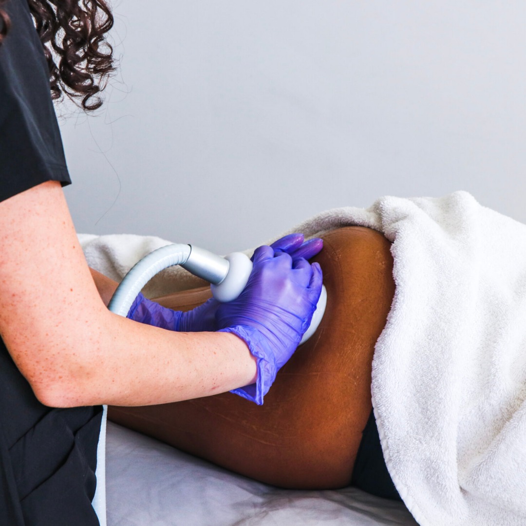 💜 Lift • Tone • Smooth 💜
Looking for a natural way to enhance your curves? Our Brazilian Butt Lift with CryoToning® uses cold therapy to:
✨ Tighten and firm the skin
✨ Stimulate collagen for a lifted look
✨ Reduce the appearance of cellulite
✨ Enhance your shape—no needles, no downtime!
Whether your goal is a smoother silhouette or that extra lift, CryoToning® gives you results you can see and feel.
📞 Call us at 440-942-6700 to schedule your consultation.
🌐 Visit: www.justmetimewellness.com
#CryoToning #BrazilianButtLift #CelluliteFree #BodyConfidence #BootyGoals #NonInvasiveTreatment #JustMeTimeWellness #EastlakeOhio