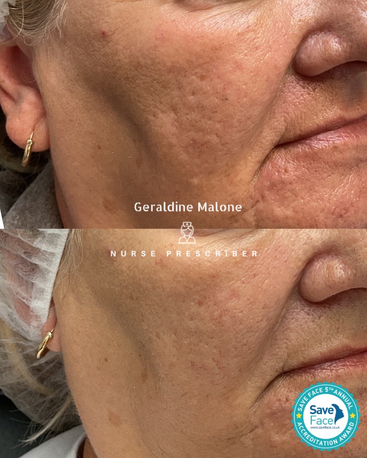Before & After Radio-Frequency Microneedling, 2 Sessions.
Clinically proven skin rejuvenation using a combination of microneedling and radiofrequency energy to stimulate collagen, tighten skin, and improve overall texture.
This treatment delivers controlled thermal energy deep into the dermis, triggering natural skin remodeling and boosting elastin production for firmer, smoother skin. Ideal for fine lines, acne scars, and skin laxity.
For optimal results, a course of 3 treatments is recommended, spaced 4–6 weeks apart, followed by maintenance sessions every 6–12 months.
Book now via the link below to see how RF Microneedling can work for you.
📍 Save Face Registered Clinic in CV6 1EB
☎️ 024 7792 1812
📩 geraldinemaloneaesthetics@outlook.com