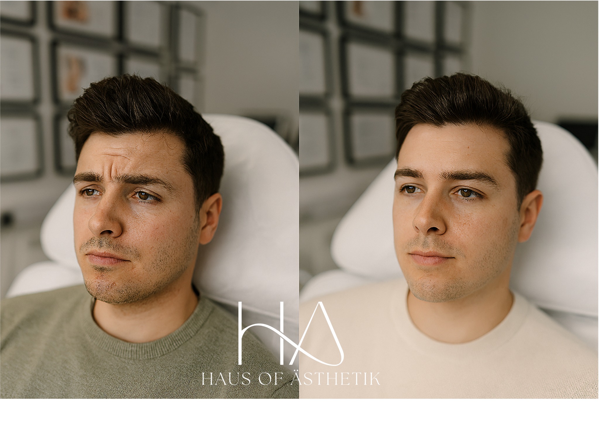 Anti-Wrinkle Treatment
Confidence doesn’t have to come with compromise.
Our patient sought to soften frown lines and refresh his appearance without losing expression, and two weeks post-treatment, the results speak for themselves. A smoother forehead, softened crow’s feet, and a more relaxed, lifted look, all without looking “done.”
Presented: 10th July - Follow-up today
📸 Left = Before | Right = 2-Week Review
This treatment is ideal for those noticing:
✔️ Forehead lines
✔️ Frown lines between the brows
✔️ Crow’s feet around the eyes
✔️ Tension in the upper face
Neuromodulators work in the case of this gentleman (Relfydess) by relaxing targeted muscles that cause dynamic lines, resulting in a softer, more youthful expression, while still allowing natural movement.
💡 Let’s bust a myth:
Anti-wrinkle injections aren’t about freezing your face. When done well, they soften lines and help you look more rested, balanced, and at ease.
✨ Thoughtfully placed. Naturally refreshed.
No one needs to know — unless you want them to.
Want to feel like your best self again? We offer personal consultations in a private clinic setting, tailored around you.
📍 Located in the heart of Bakewell
📞 01629 385318
📩 DM us or visit www.HausOfAsthetik.com to book
📸 Patient has consented to these images being shared for promotional use.
#HausOfAsthetik #AntiWrinkleTreatment #BotoxBeforeAfter #ConfidenceInSkin #GlowUpGoals #WrinkleRelaxing #BakewellAesthetics #AestheticClinicUK #FeelingRefreshed #SaveFaceClinic #CQCAlignedCare #NaturalResults #MaleAestheticsUK