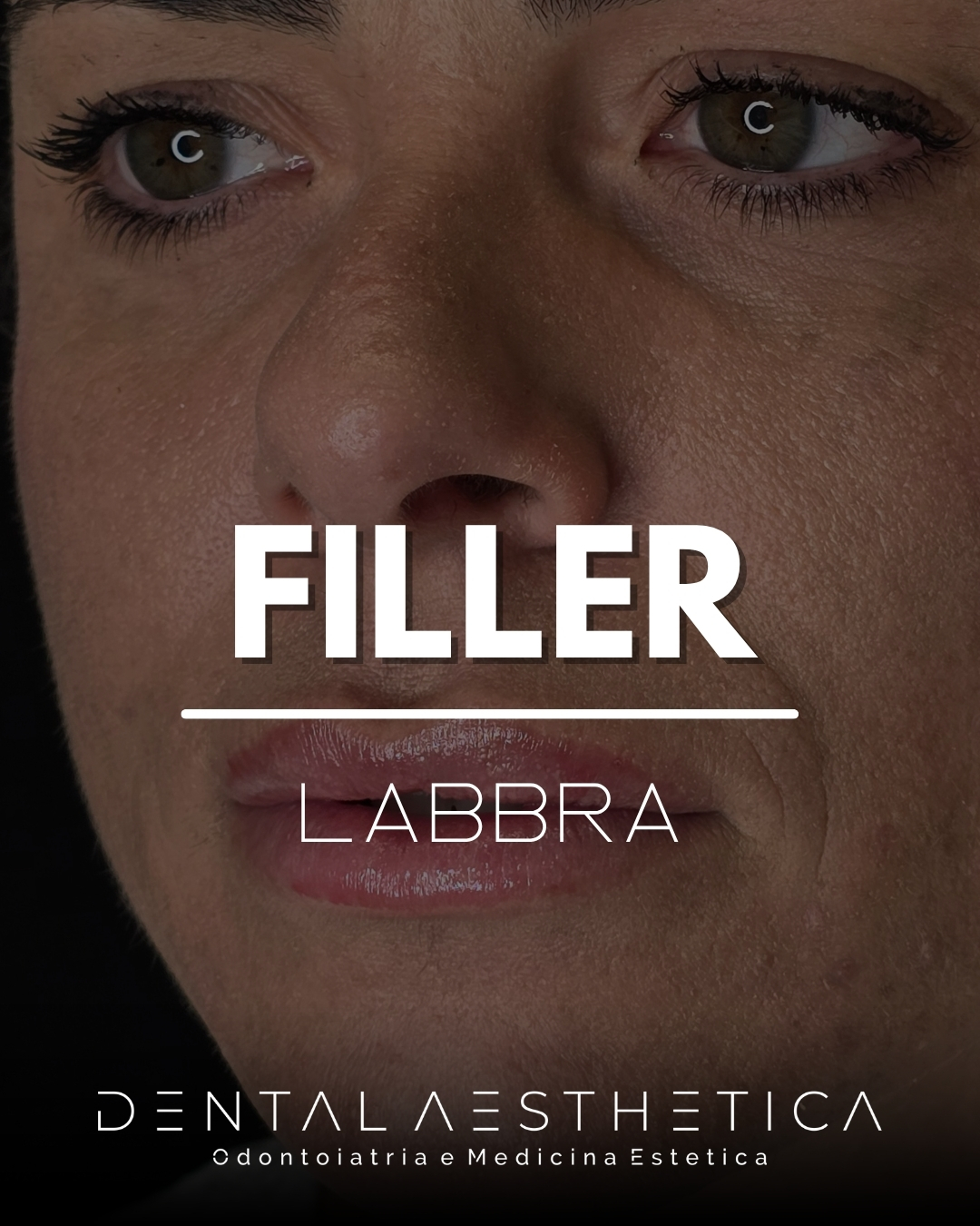#Labbra naturali e valorizzate con #filler di acido ialuronico.
#Fillerlabbra per la definizione dei profili e un aspetto più idratato e voluminoso, mantenendo un aspetto naturale.
🏠Dental Aesthetica
👨⚕️Doc. Claudio Marinelli
💧 RHA Kiss - Teoxane
📍 viale della Grande Muraglia 256, zona EUR-Torrino
📱 375 88 47 069
#lipfiller #medicinaestetica