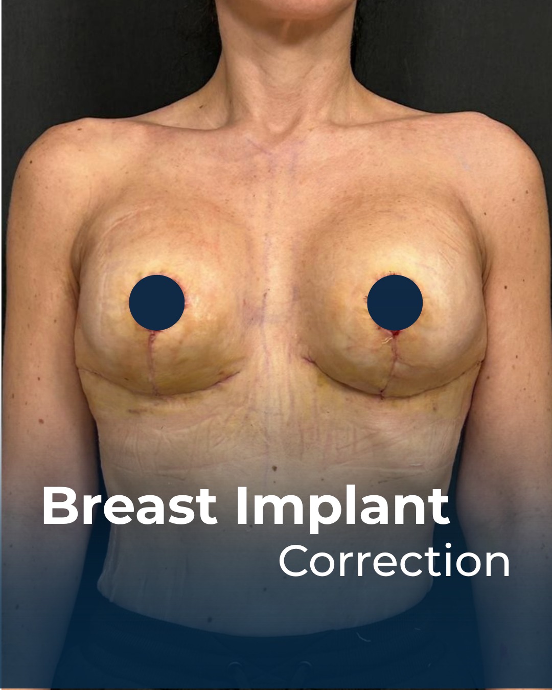 ✨1 week post-op following implant exchange, capsulectomy, and lift. This patient previously had breast implants but experienced capsular contracture along with skin laxity after weight loss. We performed a capsulectomy, implant exchange, and breast lift to restore a natural, fuller, and more youthful contour.
At just 1 week post-op, the implants appear higher and rounder than their final shape — this is completely normal. Over time, they will settle and take on a softer, teardrop-like appearance. Even at this early stage, the improvement is already remarkable. 💫
#breastlift #breastrevision #breastimplantexchange #capsulectomy #breastsurgery #breastcorrection#breastaugmentationrevision #drsemihyildiz
Patient privacy was ensured with partial removal of moles and tattoos digitally.
📌 Outcomes of surgical or interventional procedures may vary from person to person. It is recommended that you consult your physician for detailed information prior to any procedure. Dr. Semih Yıldız is certified in Health Tourism by the Ministry of Health of the Republic of Türkiye and is authorized to accept international patients. This account is intended solely for health tourism purposes, and all content is shared with the individuals’ consent for informational and educational use only.