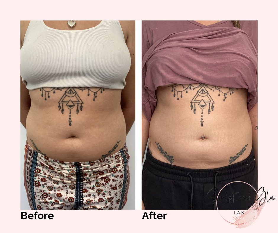 ✨Client Journey✨
This gorgeous gal wanted to work on her abdomen, sometimes all it takes is a subtle difference that really boosts someones confidence 💜
This is a perfect example of how we tailor our treatments to suit an individuals goals 🙌
She had a total of 2x Intensive Slimming treatments and 2x RF Skin Tightening treatments to the abdomen.
1x Intensive Slimming treatment $129!*
1x RF Skin Tightening treatments $69!*
This also includes COMPLIMENTARY application of @skingenau #slimminggel 👏
Slimming Gel 200mls $79.99!
Curious about the treatments we offer at @sculptandglowlab?
Drop us a DM NOW for more information 🤩
*Treatment isn't for everybody. Contact @sculptandglowlab for further information. Individual results may vary.
.
.
#realresultsrealpeople #resultsdriven #fatcavitationperth #intensiveslimmingperth #rfskintighteningperth #bodysculptingspecialistperth #bodycontouringspecialistperth #nurseledclinic #sculptandglowlab