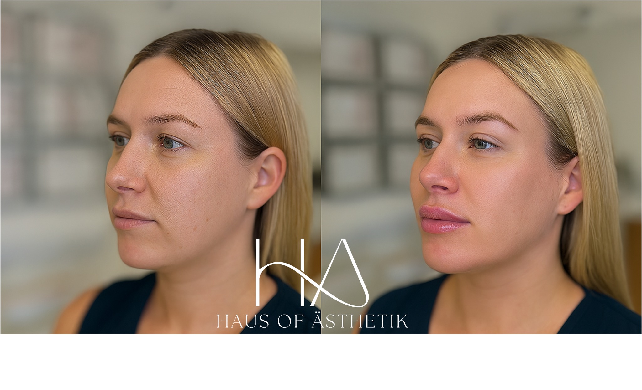 Confidence looks good on you.
This beautiful patient visited us at Haus of Ästhetik for her very first treatment, and what a joy it was to welcome her! After a relaxed, pressure-free consultation, she opted for subtle lip enhancement using just 1ml of Mesoestetic’s expertly formulated dermal filler.
The goal? A soft, balanced result that gently defines and hydrates, enhancing her natural beauty, not changing it.
Our approach is all about empowerment, helping you feel confident in your skin at any age. Whether it’s your first visit or your fifth, we listen, guide, and work with you to achieve results that feel like you, only fresher.
Thursday 10th July
📸 Left = Before | Right = Immediately After
📍 Discreetly located in the heart of Bakewell
📅 Book via www.HausOfAsthetik.co.uk
📞 Call: 01629 385318
📩 DM us to ask questions or schedule a consultation
📸 The patient consented to images being shared for business promotion.
#HausOfAsthetik #NaturalEnhancement #LipFillerBakewell #ConfidenceStartsHere #PeakDistrictAesthetics #SubtleResults #YouButRefreshed #BakewellBeauty #MesoesteticUK #DermalFillerUK #SkinConfidence #glowfromwithin