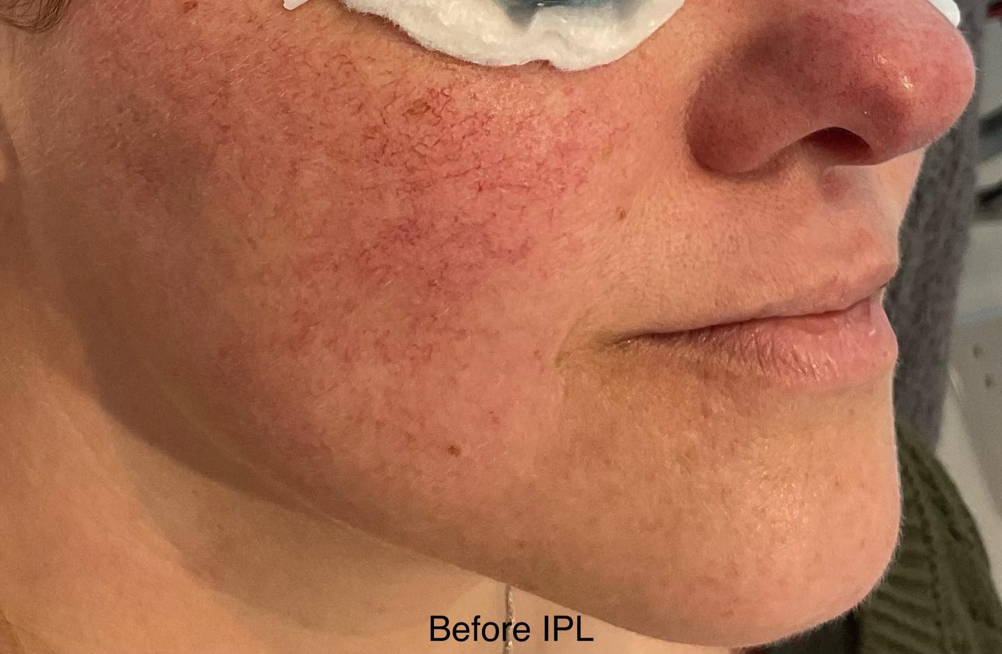 ✨ Look at the fab reduction of thread veins for our lovely client! ✨
These photos were taken after just TWO treatments and right before her third — she's currently in the middle of her journey with us! 💫
We typically recommend 3–4 IPL treatments at 4-week intervals for the best results.
📍 Using IPL (Intense Pulsed Light) technology, we've already seen improvements such as:
-Brighter, more even skin tone
-Reduced redness
-Fewer visible thread veins
-Noticeable reduction in facial flushing
📅 Book your FREE consultation and patch test today!
Let’s get you glowing with confidence. 💕
#IPLResults #ThreadVeinRemoval #EvenSkinTone #RednessRelief #SkinTransformation #BeforeAndAfter #AestheticsClinic