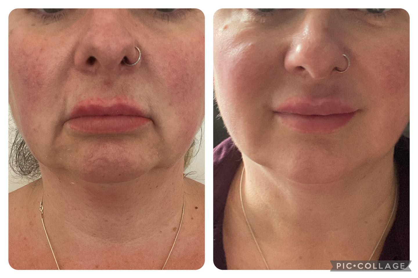 This is me!
I take care of myself and eat reasonably healthily and for turning 50 this year I don’t think I look too bad. 😍
But thanks to my mum I have inherited jowels. Really feel they age my face. Being in my industry I could have tackled them before now but that never really happens. Always the last to do ourselves. 🫣
But I took the plunge and tackled it. And am delighted with the results. Not perfect but improved and that is what I always aim for. X
So what I did was:
⭐️Botox in the depressor muscle that pulls the corners of the mouth down.
⭐️Botox in my chin (mentalis) so soften the tightness
⭐️Botox along under my jawline on the platysmal muscle which tighten with age and use pulls at our jawline
⭐️Botox along the platysmal bands which run down my neck and again pull at the neck and jaw skin causing thst drag.
⭐️Little filler in my nose to mouth lines.
⭐️Filler in my mouth to chin lines to create a bit of scaffolding in that area and to fill the gaps created by the droop
Picture 1 before. Resting b**ch face.
Picture 2 just after. (I did bruise quite a bit after. Hard doing it yourself)!
Picture 3. 3 weeks later. Botox has kicked in. Muscle pulls softened. Filler settled. Bruising gone. I am
Super happy.
If you want to find out how I can do this for you and soften and relax and turn back a few years on your lower face message me to have a chat. 07368884156