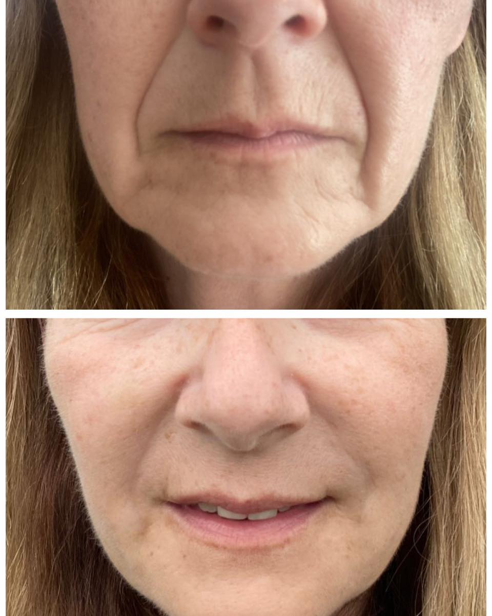Loving this lower face rejuvenation using filler from nose to mouth. Filler around the marionette lines. Targeted Botox on the lower part of the face to help with muscles pulling the face down.
Client is super happy.
#nasolabialfolds #marionette #facialfillers #lifting #faciallift #antiageing