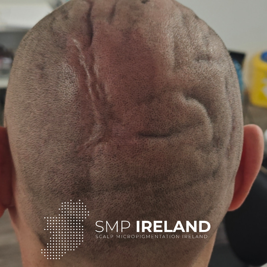 CVG (Cutis Verticis Gyrata) And a scar cover. Client was super happy and loved his new look!!!!!
Scalp Micropigmentation is a pmu procedure that uses a method similar to a tattoo to replicate hair follicles on your scalp. No hair grows from this procedure.
At SMP Ireland:
We tailor each hairline to every individual client.
We restore the image of having a full head of hair
We only use the highest standard quality products to ensure you get the best look.
No bleeding, no swelling and no scabbing.
Any redness disappears within 24 hours.
Some of the things we tackle are the following:
Thinning hair
Receding hairlines
Add hair density
Create symmetry
Male pattern baldness
Female pattern baldness
Alopecia
Hair loss.
FUT and FUE scarring camouflage
If interested DM, text, call email or check my website for quotes.
All consultations are free and payment plans are available.
Please feel free to follow to see our customer transformations.
Based in Limerick city, Ireland serving Ireland.
#beboldnotbald #trusttheprocess #pmuireland #smpireland #limerickcity #limerick
#limerickbusiness #bald #hair #scalpmicropigmentationireland #hairloss #balding #beautyireland #aestheticireland #baldingsolutionireland #confidencerestored
#CVG #CutisVerticisGyrata #scarcamouflage