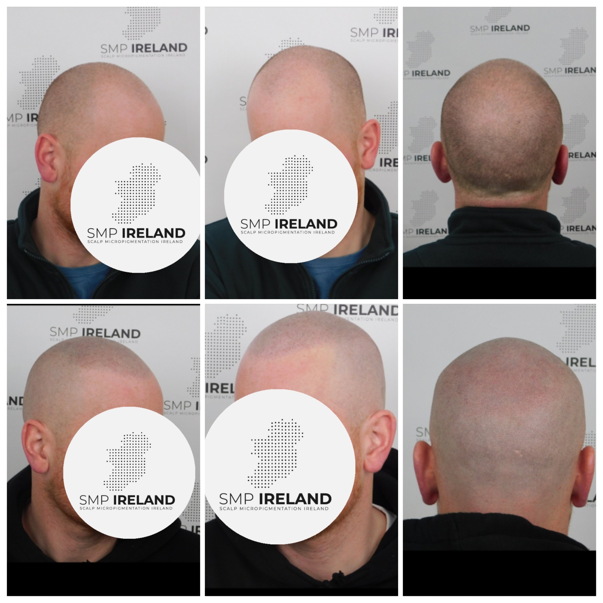 Nice before and afters!!!!!
Scalp Micropigmentation is a pmu procedure that uses a method similar to a tattoo to replicate hair follicles on your scalp. No hair grows from this procedure.
At SMP Ireland:
We tailor each hairline to every individual client.
We restore the image of having a full head of hair
We only use the highest standard quality products to ensure you get the best look.
No bleeding, no swelling and no scabbing.
Any redness disappears within 24 hours.
Some of the things we tackle are the following:
Thinning hair
Receding hairlines
Add hair density
Create symmetry
Male pattern baldness
Female pattern baldness
Alopecia
Hair loss.
FUT and FUE scarring camouflage
If interested DM, text, call email or check my website for quotes.
All consultations are free and payment plans are available.
Please feel free to follow to see our customer transformations.
Based in Limerick city, Ireland serving Ireland.
#beboldnotbald #trusttheprocess #pmuireland #smpireland #limerickcity #limerick
#limerickbusiness #bald #hair #scalpmicropigmentationireland #hairloss #balding #beautyireland #aestheticireland #baldingsolutionireland #confidencerestored
#beauty #hairline