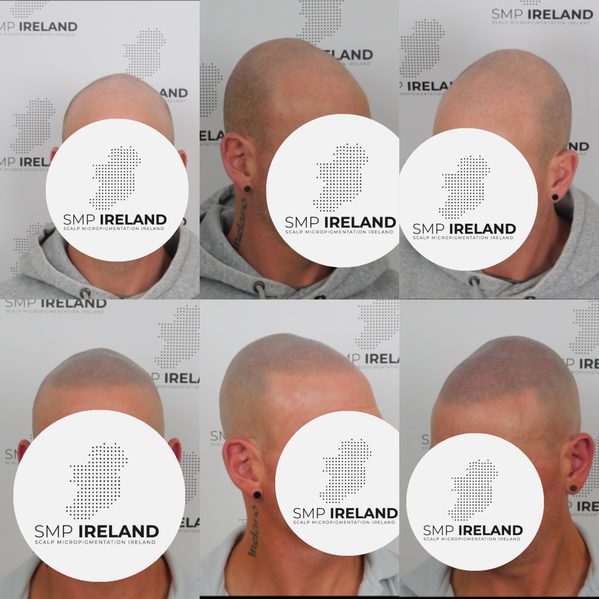 This sound fella looking fresh after his SMP!!!!!!
Scalp Micropigmentation is a pmu procedure that uses a method similar to a tattoo to replicate hair follicles on your scalp. No hair grows from this procedure.
At SMP Ireland:
We tailor each hairline to every individual client.
We restore the image of having a full head of hair
We only use the highest standard quality products to ensure you get the best look.
No bleeding, no swelling and no scabbing.
Any redness disappears within 24 hours.
Some of the things we tackle are the following:
Thinning hair
Receding hairlines
Add hair density
Create symmetry
Male pattern baldness
Female pattern baldness
Alopecia
Hair loss.
FUT and FUE scarring camouflage
If interested DM, text, call email or check my website for quotes.
All consultations are free and payment plans are available.
Please feel free to follow to see our customer transformations.
Based in Limerick city, Ireland serving Ireland.
#beboldnotbald #trusttheprocess #pmuireland #smpireland #limerickcity #limerick
#limerickbusiness #bald #hair #scalpmicropigmentationireland #hairloss #balding #beautyireland #aestheticireland #baldingsolutionireland #confidencerestored
#sound #fresh