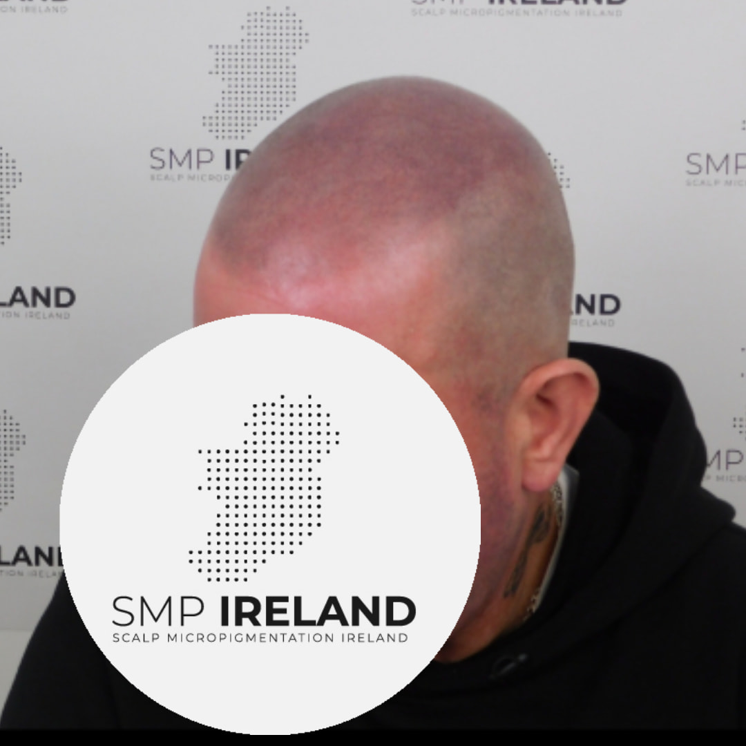Take years off your look!!!!!
Scalp Micropigmentation is a pmu procedure that uses a method similar to a tattoo to replicate hair follicles on your scalp. No hair grows from this procedure.
At SMP Ireland:
We tailor each hairline to every individual client.
We restore the image of having a full head of hair
We only use the highest standard quality products to ensure you get the best look.
No bleeding, no swelling and no scabbing.
Any redness disappears within 24 hours.
Some of the things we tackle are the following:
Thinning hair
Receding hairlines
Add hair density
Create symmetry
Male pattern baldness
Female pattern baldness
Alopecia
Hair loss.
FUT and FUE scarring camouflage
If interested DM, text, call email or check my website for quotes.
All consultations are free and payment plans are available.
Please feel free to follow to see our customer transformations.
Based in Limerick city, Ireland serving Ireland.
#beboldnotbald #trusttheprocess #pmuireland #smpireland #limerickcity #limerick
#limerickbusiness #bald #hair #scalpmicropigmentationireland #hairloss #balding #beautyireland #aestheticireland #baldingsolutionireland #confidencerestored
#hair ##hairline
