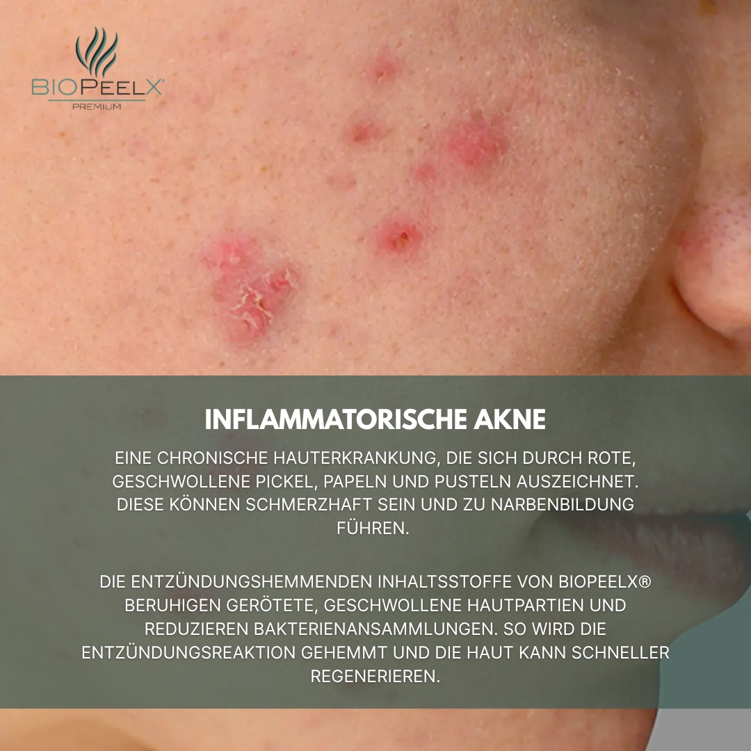 BiopeelX® bietet eine ganzheitliche Lösung bei allen Formen von Akne – von Mitessern über entzündliche und zystische Formen bis hin zu hormoneller oder pilzbedingter Akne. Durch seine peelende, entzündungshemmende und talgregulierende Wirkung unterstützt es die Haut sanft, effektiv und nachhaltig auf dem Weg zu einem klareren Hautbild.
#biopeel #biopeelx #biopeeling #BioPeelX #biopeelx® #biopeelx❤️ #biopeelxmagic #biopeelxtreat #biopeelxpremium #biopeelxandstemcell #antiacne #antiacnefacial #AntiAcneSolution #antiacnetreatment