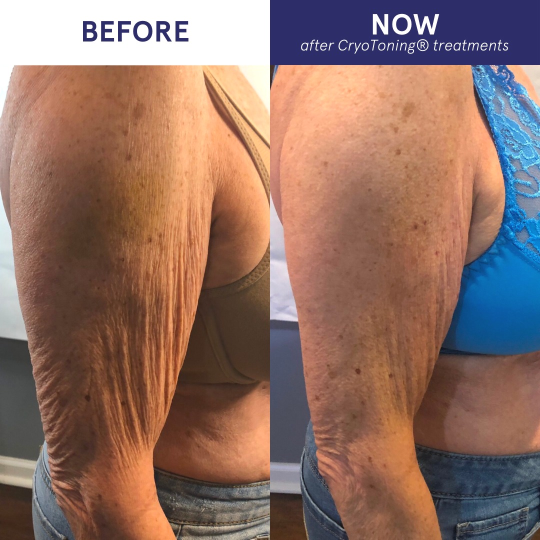 Hurry—limited to the first 10 people who will snag this exclusive offer! Perfect for anyone ready to slim down their waistline (or other trouble spots) without draining their wallet. Don’t miss your chance to save and sculpt!
❄Get 10 CryoSlimming and CryoToning treatments. (reg. $2,749.95)
❄Get 6 Lipolaser treatments (reg. 999.95)
All for just $2,999.95 ($750 savings). Financing options are available with 0% interest for up to 24 months!
#fatloss #fatlosstips #skincare #skingoals #cellulite #skintightening #nopain #nodowntime #selfimprovement #selfcare