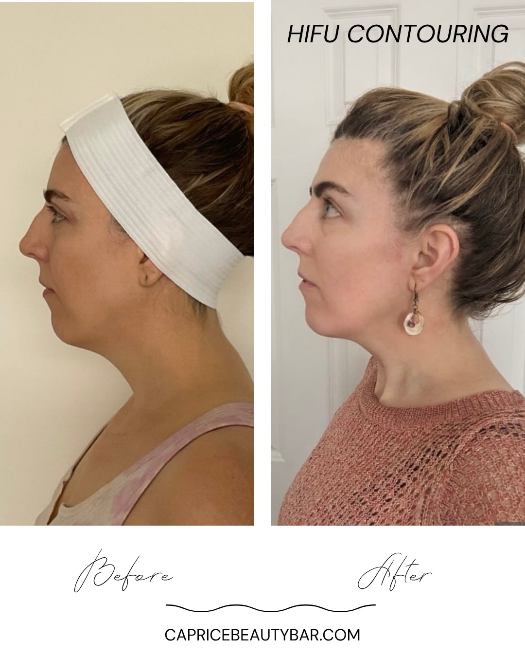 Looking to get rid of a double chin or “turkey neck” without surgery or a lot of down time, this may be the treatment you’ve been searching for.
Hifu is a better alternative…
💡 Why choose HIFU?
1. Natural Lift: Boosts your body’s own collagen for firm, youthful skin
2. No Needles: Completely non-invasive with zero bruising or swelling
3. No Downtime: Walk in, walk out, no recovery needed
4. Longer-Lasting: Results that improve over time and last up to a year
✨ A gentle, effective way to get results…without the poke!
Book now at: www.capricebeautybar.com or call 201-961-5571