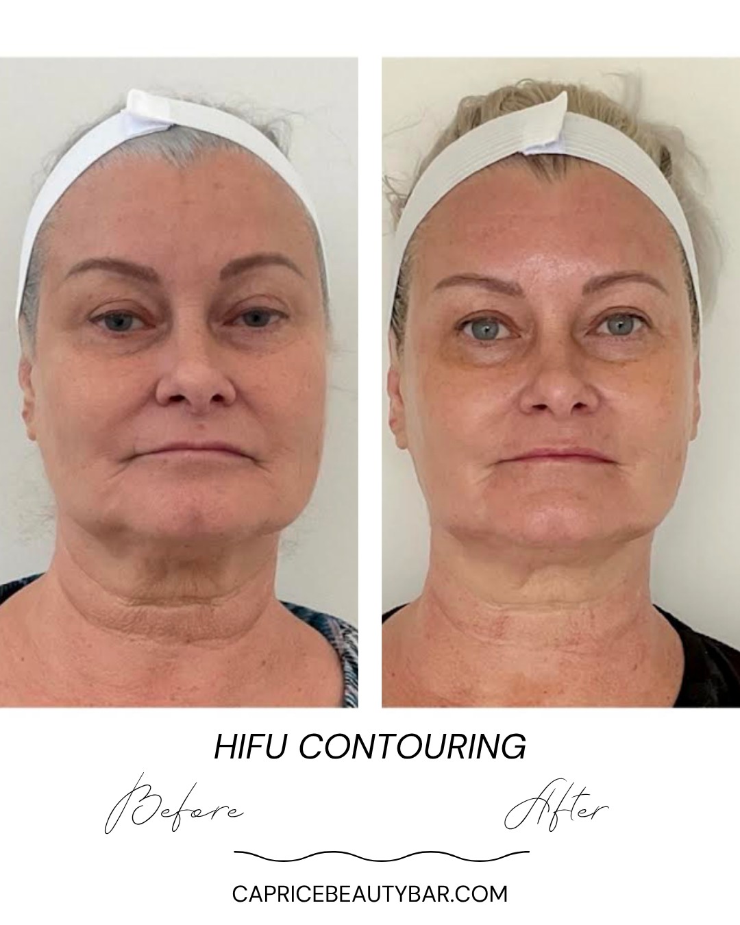 ✨ Want a lift without downtime?
Meet HIFU, your non-surgical facelift & body boost 👏
🔹 Boosts collagen (hello, glow!)
🔹 Targets deep layers without hurting the surface
🔹 No needles, no downtime
🔹 Smooths wrinkles + slims problem areas
🔹 Results keep getting better over time
🎯 Perfect for aging gracefully, and staying ahead of it.
Tighten and tone your jawline and neck for a better profile view and increased confidence. In just “ # of treatments” you can achieve results like this. See our client before and afters, beautiful results.
Call 201-961-5571, or visit www.capricebeautybar.com to book your appointment.