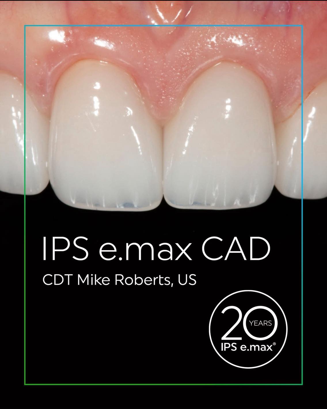 Where digital precision meets exceptional esthetics.
Expertly designed as minimally invasive three-quarter crowns, these restorations were precisely milled from
IPS e.max CAD lithium disilicate glass ceramic - ensuring both strength and translucency.
To complete the look, they were individualized with IPS e.max Ceram, achieving a lifelike and true-to-life finish that seamlessly blends - for a naturally beautiful smile!
An exemplary IPS e.max case by CDT Mike Roberts
(US).
Discover more: https://bit.ly/GFBfo-emax2025
حيث تلتقي الدقة بالجمال الاستثنائي.
تم تصميم هذه الترميمات بخبرة لتكون تيجانًا ثلاثية الأرباع ، وتم خرطها بدقة باستخدام
IPS e.max CAD Lithium disilicate glass ceramic- لضمان القوة والشفافية.
ولإكمال المظهر، تم تصميمها بشكل فردي باستخدام IPS e.max Ceram، لتحقيق لمسة نهائية واقعية - و الحصول على ابتسامة جميلة بشكل طبيعي!
حالة نموذجية لـ IPS e.max . القائم بالعمل CDT Mike Roberts (الولايات المتحدة).
For more information on our products and for our latest promotions call us on
: 24513870 - 24513874
لمزيد من المعلومات و للاستعلام اتصل بنا : 24513870 - 24513874
#Ivoclar #emax #allceramic #emaxceram #emax20 #عيد_و_كبريته #ايفوكلار #جودة_عالية #جودة_تثق_بها