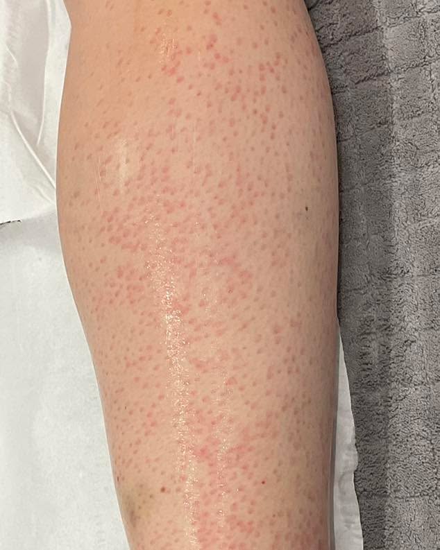 Here’s a close-up look at what the skin typically looks like immediately after laser hair removal — slight redness and mild swelling around the follicles is completely normal! 💥✨
✅ This reaction is temporary and usually subsides within a few hours to a day.
🔹 Aftercare Tips to soothe and protect your skin:
– Avoid hot showers, saunas, or intense workouts for 24–48 hours
– Apply aloe vera gel to cool, soothe, and hydrate the skin
– Avoid direct sun exposure and wear SPF daily for at least 4 weeks
– Refrain from scrubbing, exfoliating, or wearing tight clothing on the treated area for a few days
🕒 Hair Shedding Timeline:
– Hair will begin to shed around 1 week after treatment on the face
– For the body, expect shedding to start around 2 weeks post-treatment
Once the skin has fully settled (typically after 5–7 days), you can begin to gently exfoliate the area. This helps to lift the treated hairs as they shed naturally from the follicles. 🛁✨
Be patient — smooth, hair-free skin is on the way! 💖