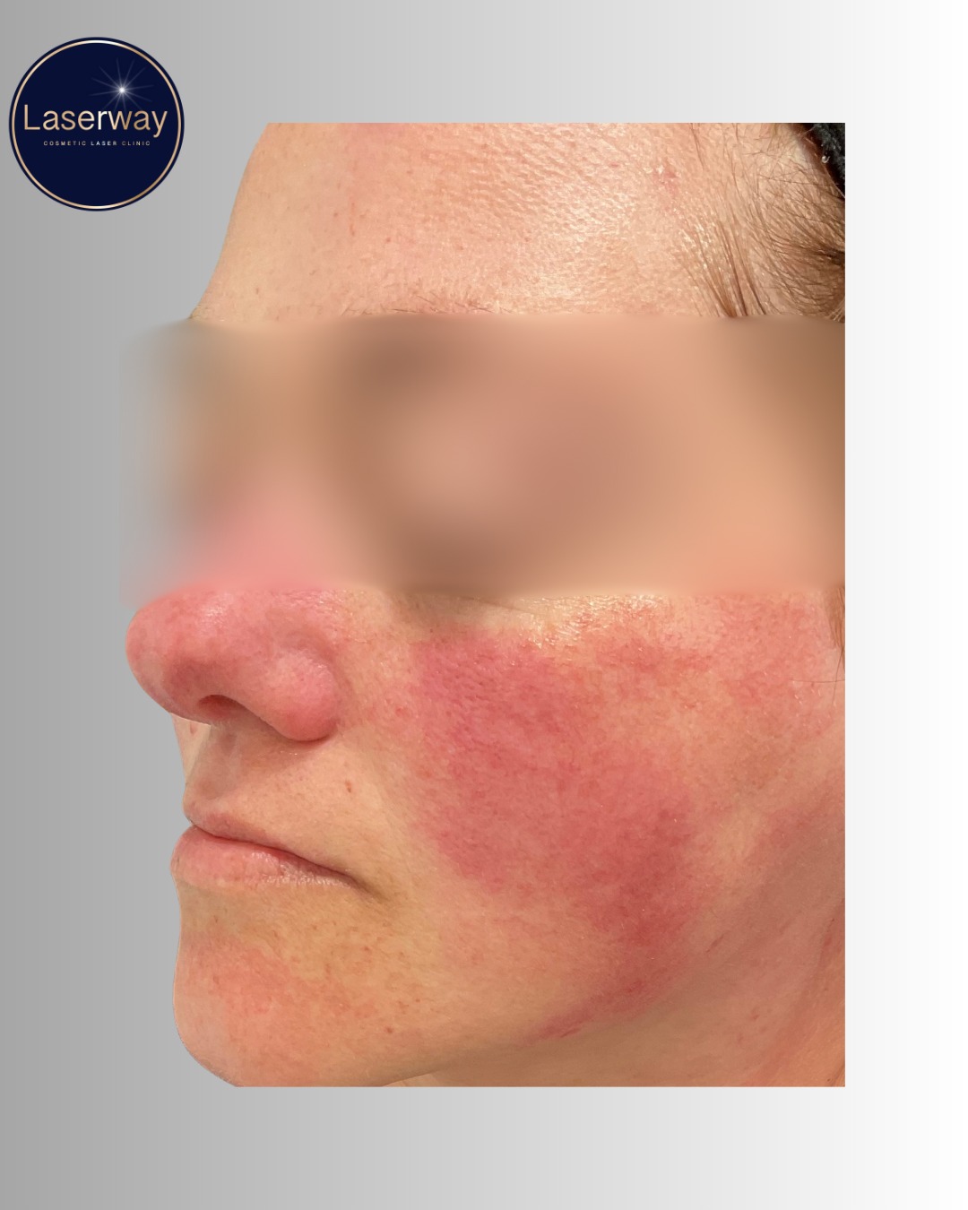 📸 Immediately After Intense Pulse Light (IPL) treatment
What We Treated:
✔️ Veins on the cheeks and nose
✔️ Skin rejuvenation across the rest of the face
🔍 What You're Seeing Post-Treatment:
➡️ Skin rejuvenation:
• No to mild redness
• Usually settles before you leave the clinic
• Freckles/pigmentation will darken over the next few days and naturally shed within 7–14 days
➡️ Vein areas treated:
• Expect heat and redness for a few hours after treatment
• Swelling is most common in the upper cheeks
• Swelling typically lasts up to 3 days, but may take longer for some
Aftercare:
-No exfoliating or picking pigmentation areas for 2 weeks
-Avoid heat (hot showers, saunas, intense exercise)
-Apply Aloe Vera — TIP: keep it in the fridge for extra cooling!
-Use a cold compress
-Wear SPF daily
📅 Treatment Plan:
A course of 3 treatments, spaced 4 weeks apart, is recommended
🍂 As autumn/ winter approaches, this is the perfect time to start IPL as
✅ Less sun exposure (important to avoid sun 4 weeks before & after laser)
✅ Skin is at its palest for safer, more effective treatments
DM us for more info or to book your free skin consultation and patch test
#IPL #PostIPL #SkinRejuvenation #VeinTreatment #PigmentationTreatment #SkinClinic #LaserFacial #RealResults #GlowingSkin #AutumnSkinCare #SPFDaily