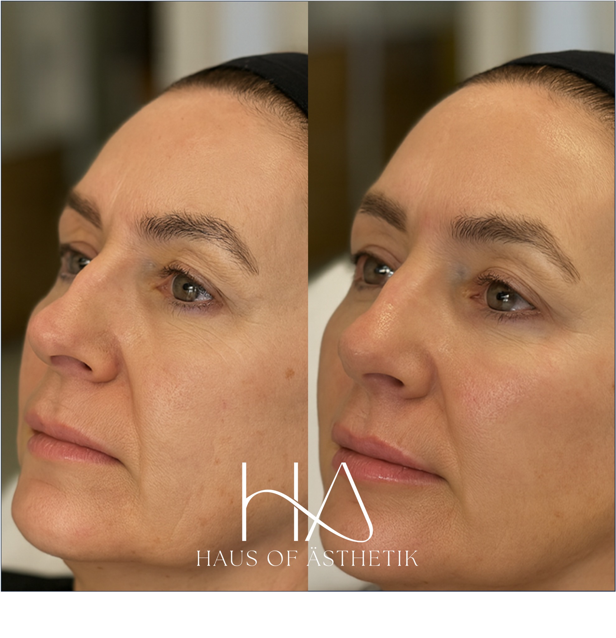 ✨ Full-Face Refresh for a Natural, Elegant Lift ✨
Polynucleotide treatment with Croma Eye was used to hydrate and soften the under-eye area, reducing the appearance of hollowness and fatigue. Treatment is performed using a cannula for maximum safety and minimal bruising.
👁 Tear Troughs:
Polynucleotide treatment with Croma Eye was used to hydrate and soften the under-eye area, reducing the appearance of hollowness and fatigue. Treatment is performed using a cannula and needle for maximum safety and minimal bruising.
💋 Lips:
A gentle enhancement using 0.7ml of Teoxane RHA® Kiss to restore upper lip shape and volume, achieving a soft, hydrated finish that complements the lower face without overpowering it.
🪄 Cheeks & Jawline:
1 mL of Teoxane RHA 4 was placed in the midface and lateral cheek to restore volume and subtly lift the lower face, enhancing the jawline and improving facial balance.
✨ The result? A refreshed, confident appearance, no overfilling, just refined structure and smooth transitions.
All treatments are performed at a Save Face-accredited clinic in Bakewell.
📞 01629 385318
📍 4 Portland Square, Bakewell
🖥️ www.HausOfAsthetik.co.uk
📩 DM to book your personalised consultation
🗓️ Tuesday 26th July
📸 Left = Before | Right = Immediately Post Filler
📸 Client provided full consent for clinical photography and promotional use.
#MidfaceRejuvenation #HausOfAsthetik #SaveFaceAccredited #CQCClinic #BakewellClinic #Over40Skin #SubtleEnhancement #MatureSkinAesthetics