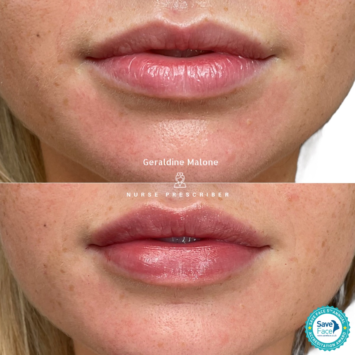 0.5ml Lip Enhancement Treatment
✨Hydration and subtle volume, whilst maintaining natural shape and proportion
- NO edited images
- Treatment price: 0.5ml/£145, 1ml/£225
- Recovery time: 24/48hrs
- Results lasting 6-12 months
All treatments carried out by Nurse Prescriber Geraldine Malone in a Save Face Registered Clinic
Book Now via the link below:
https://www.geraldinemalone.co.uk/book-appointment
Contact Us:
☎️ 024 7792 1812
📧 geraldinemaloneaesthetics@outlook.com