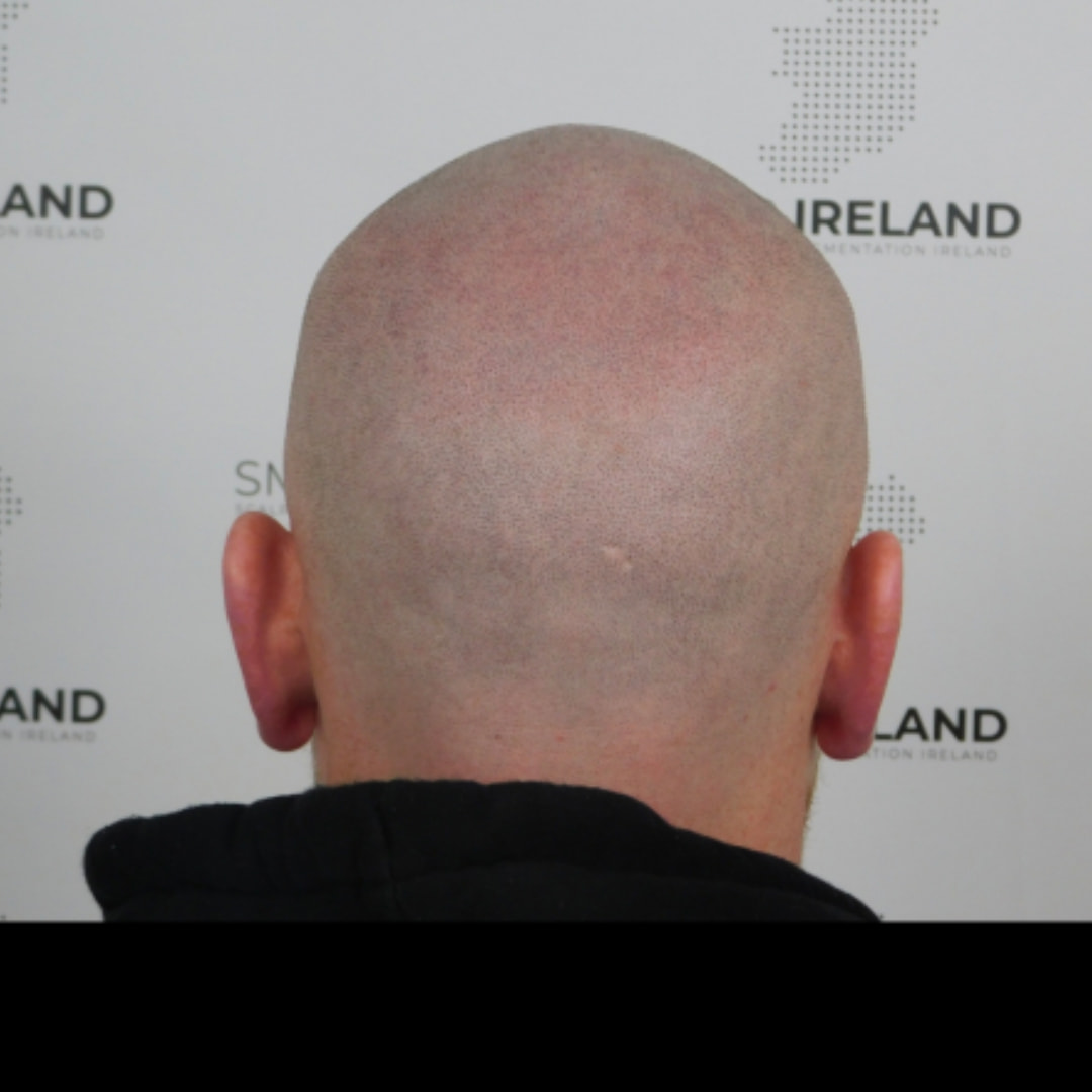 Never worry about that horseshoe again!!!!!
Scalp Micropigmentation is a pmu procedure that uses a method similar to a tattoo to replicate hair follicles on your scalp. No hair grows from this procedure.
At SMP Ireland:
We tailor each hairline to every individual client.
We restore the image of having a full head of hair
We only use the highest standard quality products to ensure you get the best look.
No bleeding, no swelling and no scabbing.
Any redness disappears within 24 hours.
Some of the things we tackle are the following:
Thinning hair
Receding hairlines
Add hair density
Create symmetry
Male pattern baldness
Female pattern baldness
Alopecia
Hair loss.
FUT and FUE scarring camouflage
If interested DM, text, call email or check my website for quotes.
All consultations are free and payment plans are available.
Please feel free to follow to see our customer transformations.
Based in Limerick city, Ireland serving Ireland.
#beboldnotbald #trusttheprocess #pmuireland #smpireland #limerickcity #limerick
#limerickbusiness #bald #hair #baldeagle #baldisbeautiful #scalpmicropigmentationireland #hairloss #balding #beautyireland #aestheticireland #baldingsolutionireland #confidencerestored
#beauty #hairline #hairstyles #bald