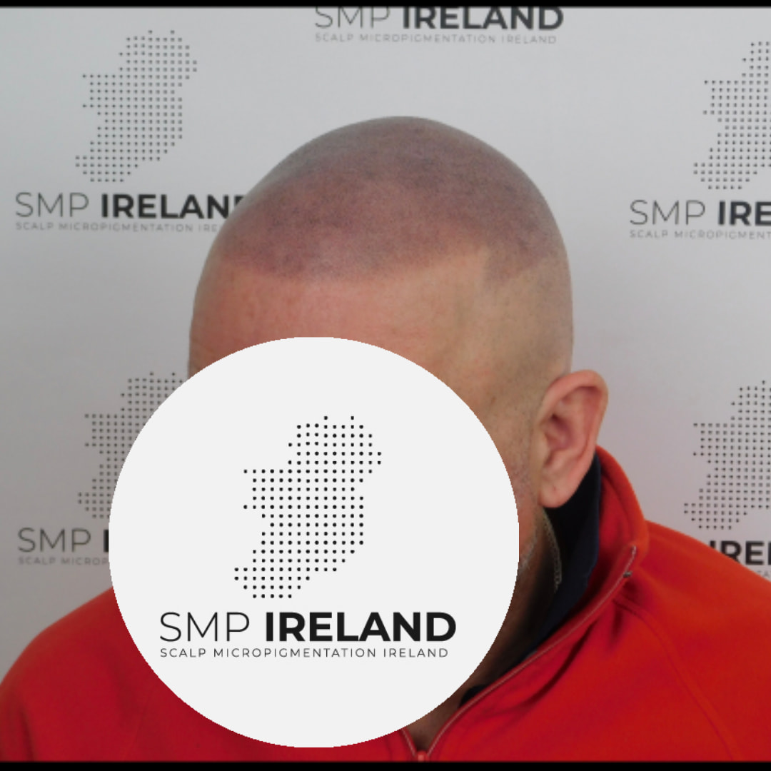 Take years of your look!!!!!
Scalp Micropigmentation is a pmu procedure that uses a method similar to a tattoo to replicate hair follicles on your scalp. No hair grows from this procedure.
At SMP Ireland:
We tailor each hairline to every individual client.
We restore the image of having a full head of hair
We only use the highest standard quality products to ensure you get the best look.
No bleeding, no swelling and no scabbing.
Any redness disappears within 24 hours.
Some of the things we tackle are the following:
Thinning hair
Receding hairlines
Add hair density
Create symmetry
Male pattern baldness
Female pattern baldness
Alopecia
Hair loss.
FUT and FUE scarring camouflage
If interested DM, text, call email or check my website for quotes.
All consultations are free and payment plans are available.
Please feel free to follow to see our customer transformations.
Based in Limerick city, Ireland serving Ireland.
#beboldnotbald #trusttheprocess #pmuireland #smpireland #limerickcity #limerick
#limerickbusiness #bald #hair #scalpmicropigmentationireland #hairloss #balding #beautyireland #aestheticireland #baldingsolutionireland #confidencerestored
#beauty #hairline #hairstyles #baldisbeautiful #thinninghair #thinninghairsolution #timemachine