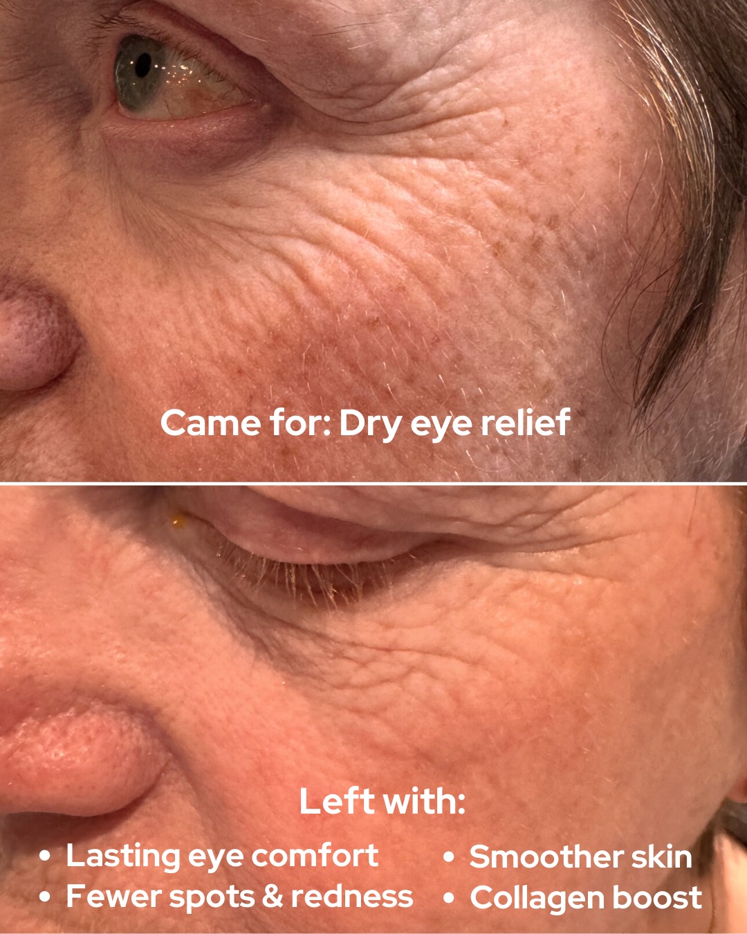 ✨ She came in hoping for dry eye relief… and discovered so much more with IPL.
Not only did her eyes feel more comfortable, but her skin tone improved too: fewer sun spots, reduced redness, smoother texture, and a natural collagen boost for lasting results.
IPL is more than dry eye therapy, it’s a treatment that supports both eye health and skin rejuvenation.
👁️ Clearer eyes.
🌸 Brighter skin.
💡 Confidence that lasts.
📲 Ask us about IPL and how it can help with both comfort and complexion.
#dryeyerelief #ipltherapy #skincarebenefits #northvancouver #lynnvalleyoptometry