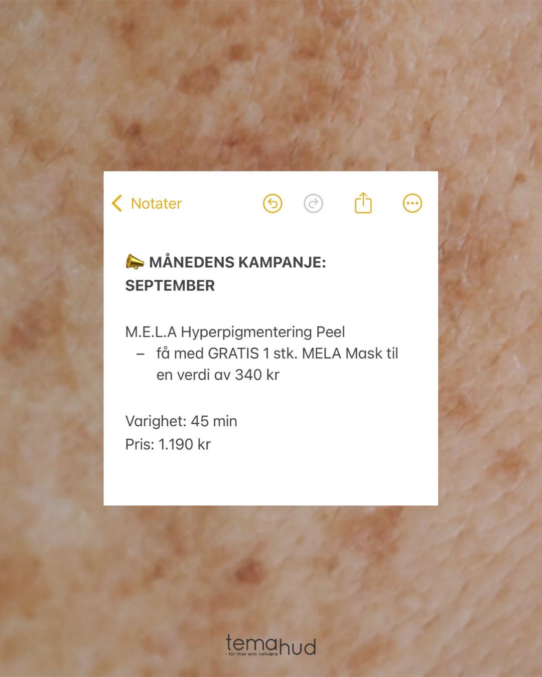 Sommeren gir oss sol og glød – men ofte også uønskede pigmentflekker. 🍂 Nå som høsten er her, og solen er mindre intens, er det den perfekte tiden å starte behandling mot hyperpigmentering.
Derfor tilbyr vi denne måneden en kampanje hvor du får med deg 1 stk. GRATIS Mela mask til hjemmebruk dersom du booker M.E.L.A Hyperpigmentering Peel behandlingen nå i september. Med denne perfekte duoen får du en skikkelig kickstart 💥
Behandlingen består av:
🫧 rens
🤎 fruktsyrepeel med pHformula MELA Powerclay
💆♀️ maske tilpasset behov med nakke- og skuldermassasje under virketid
🧴Avsluttes med påføring av Post Recovery Cream.
Denne målrettede behandlingen reduserer effektivt pigmentflekker, fremmer hudfornyelse og gir en jevnere hudtone - med synlige resultater og minimal risiko.
For husk: Behandling av hyperpigmentering starter i salong og fortsetter hjemme 🤎 Profesjonell behandling 🤝 din hjemme rutine - hånd i hånd.
Behandlingen kan bookes enkelt i vår online booking 👉🏼 under Månedens kampanje: September. *tilbudet gjelder kun i september måned.