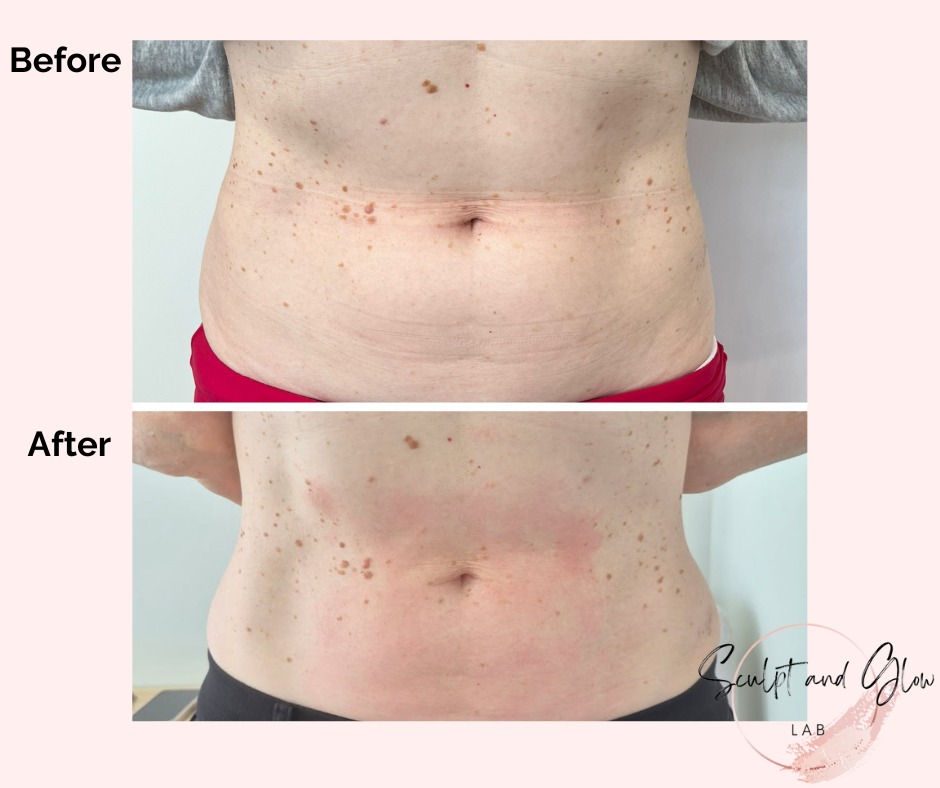 ✨Client Journey✨
HELLO snatched waist line!
This extremely fit, active and gorgeous lady wanted to target a stubborn pocket of fatty tissue on the lower abdomen. Not only have we snatched her waistline, the lax skin has tightened up significantly 👏
We ABSOLUTELY love helping people gain their confidence back!💜
She had a total of 6x treatments of Fat Cavitation and RF Skin Tightening 🙌
1x treatment of Fat Cavitation and RF Skin Tightening ONLY $89 per area!*
🤔Curious about the treatments we offer? DM us now at @sculptandglowlab for @sculptandglowlab
*Treatment isn't for everybody. Contact @sculptandglowlab for further information. Individual results may vary.
.
.
#realpeoplerealresults #clientjourney #fatcavitationperth #rfskintighteningperth #snatchedwaist #slimlux #bodysculptingspecialistperth #nurseledclinic #sculptandglowlab #confidence #welovewhatwedo