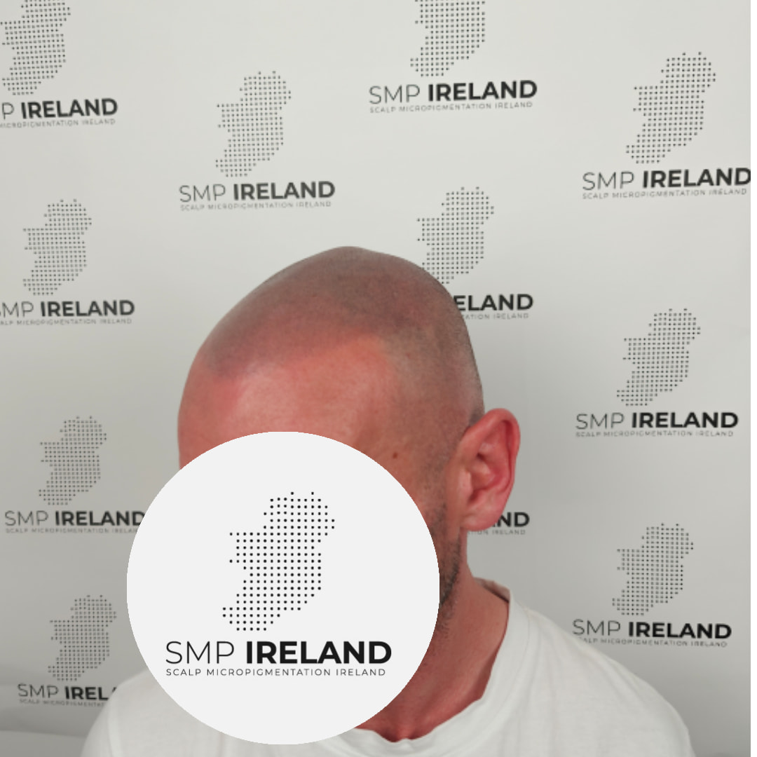 Nice soft hairline!!!!
Scalp Micropigmentation is a pmu procedure that uses a method similar to a tattoo to replicate hair follicles on your scalp. No hair grows from this procedure.
At SMP Ireland:
We tailor each hairline to every individual client.
We restore the image of having a full head of hair
We only use the highest standard quality products to ensure you get the best look.
No bleeding, no swelling and no scabbing.
Any redness disappears within 24 hours.
Some of the things we tackle are the following:
Thinning hair
Receding hairlines
Add hair density
Create symmetry
Male pattern baldness
Female pattern baldness
Alopecia
Hair loss.
FUT and FUE scarring camouflage
If interested DM, text, call email or check my website for quotes.
All consultations are free and payment plans are available.
Please feel free to follow to see our customer transformations.
Based in Limerick city, Ireland serving Ireland.
#beboldnotbald #trusttheprocess #pmuireland #smpireland #limerickcity #limerick
#limerickbusiness #bald #hair #scalpmicropigmentationireland #hairloss #balding #beautyireland #aestheticireland #baldingsolutionireland #confidencerestored
#beauty #hairline #hairstyles #baldisbeautiful #thinninghair #thinninghairsolution