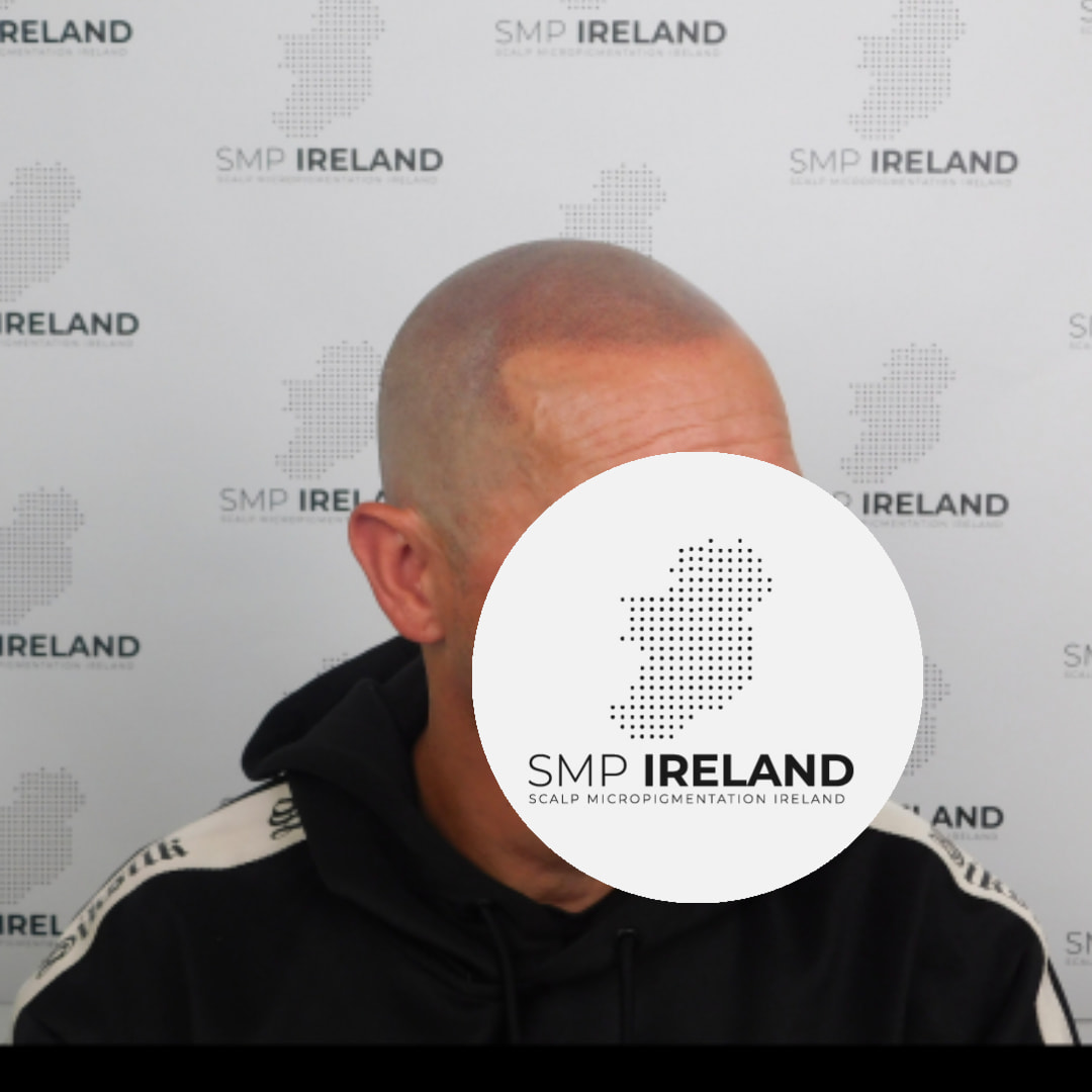 No hairline is the same. Each hairline is catered to each individual taking age, ethnicity, skin tone and customer input.
Scalp Micropigmentation is a pmu procedure that uses a method similar to a tattoo to replicate hair follicles on your scalp. No hair grows from this procedure.
At SMP Ireland:
We tailor each hairline to every individual client.
We restore the image of having a full head of hair
We only use the highest standard quality products to ensure you get the best look.
No bleeding, no swelling and no scabbing.
Any redness disappears within 24 hours.
Some of the things we tackle are the following:
Thinning hair
Receding hairlines
Add hair density
Create symmetry
Male pattern baldness
Female pattern baldness
Alopecia
Hair loss.
FUT and FUE scarring camouflage
If interested DM, text, call email or check my website for quotes.
All consultations are free and payment plans are available.
Please feel free to follow to see our customer transformations.
Based in Limerick city, Ireland serving Ireland.
#beboldnotbald #trusttheprocess #pmuireland #smpireland #limerickcity #limerick
#limerickbusiness #bald #hair #scalpmicropigmentationireland #hairloss #balding #beautyireland #aestheticireland #baldingsolutionireland #confidencerestored
#beauty #hairline #hairstyles #baldisbeautiful #thinninghair #thinninghairsolution