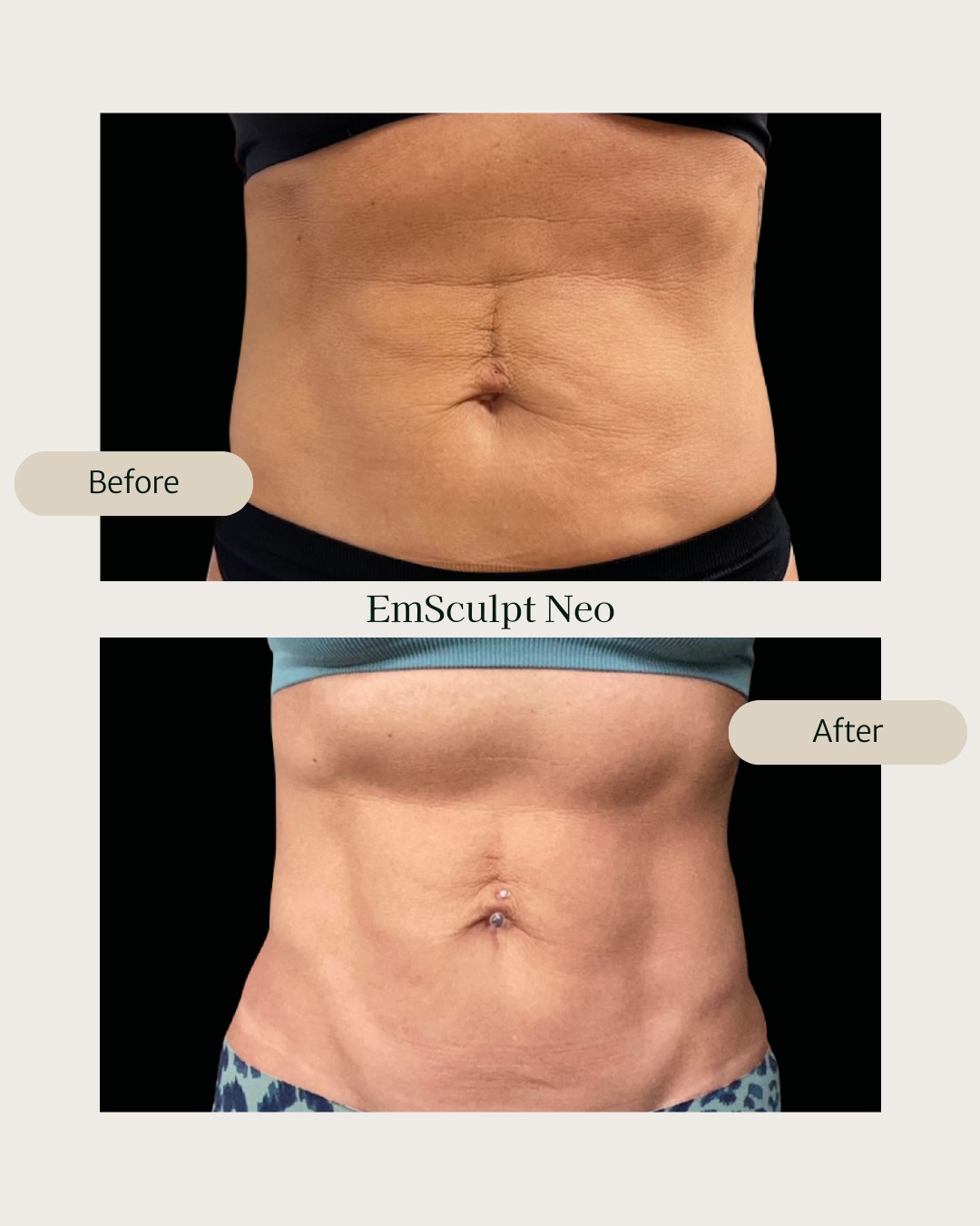Visible definition. Real results. 💪🏼
This is what some sessions of EmSculpt Neo can do: tone muscles, reduce fat, and boost confidence.
Ready to sculpt your abs without surgery or downtime?
📍Available at ALTA Aesthetics, Zurich.