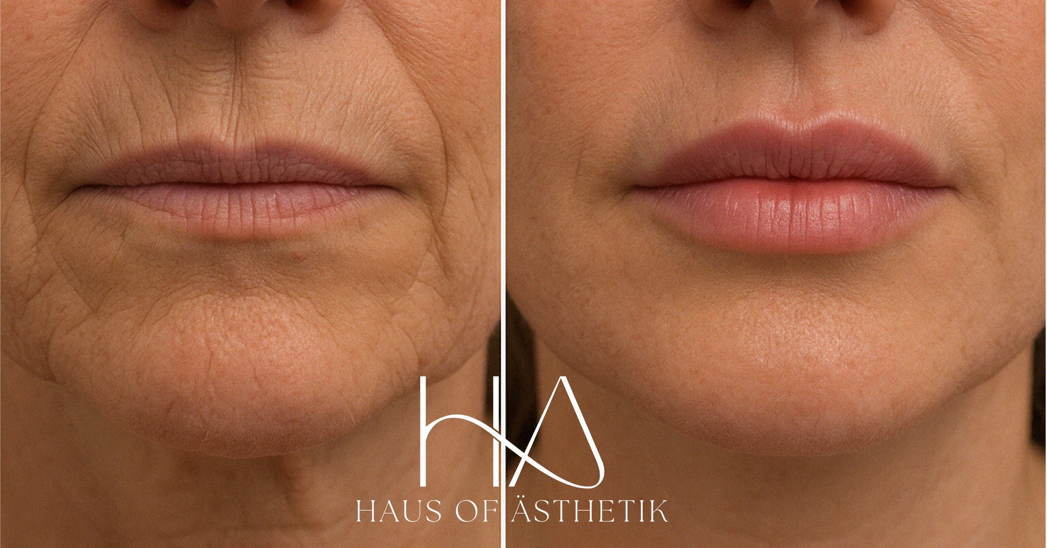 ✨ Perioral Rejuvenation in Progress ✨
This patient began her transformation journey with the goal of softening deep perioral lines and restoring hydration and definition around the lips, without creating an artificial or over-volumised look.
💉 Visit 1:
0.9ml of Mesoestetic MesoFiller® Nexha Lips was carefully placed to hydrate and gently define the vermillion border, smoothing radial lip lines and restoring subtle volume. Filler was complemented with microneedling using a custom serum tailored to skin integrity and elasticity.
🧬 Visit 1, 2 & 3:
A further two sessions of microneedling were performed using X.PROF 110 X-DNA Gel, a potent regenerative polynucleotide formula designed to improve dermal density, reduce the appearance of vertical lines, and enhance skin texture over time. This is now her fourth follow-up review only.
📸 Shown here is her skin prior to her third microneedling session, already showing clear improvement in:
• Perioral line depth
• Lip hydration and structure
• Fine textural balance across the chin and lower face
This patient’s journey is ongoing, with further collagen induction therapy and hydration layering planned for optimal long-term results.
📍 All treatments are performed using evidence-based protocols by our advanced aesthetics practitioner in Bakewell.
📞 01629 385318
📍 4 Portland Square, Bakewell
🖥️ www.HausOfAsthetik.co.uk
📩 DM to book your consultation
🗓️ Monday 22nd September
📸 Left = Before first treatment | Right = Immediately before third treatment
#LipLines #VerticalLipLines #PerioralRejuvenation #Mesoestetic #NexhaLip #XPROF110 #MicroneedlingResults #HausOfAsthetik #BakewellAesthetics #SkinConfidence #SubtleEnhancement #Over50Skin #MatureSkinClinic