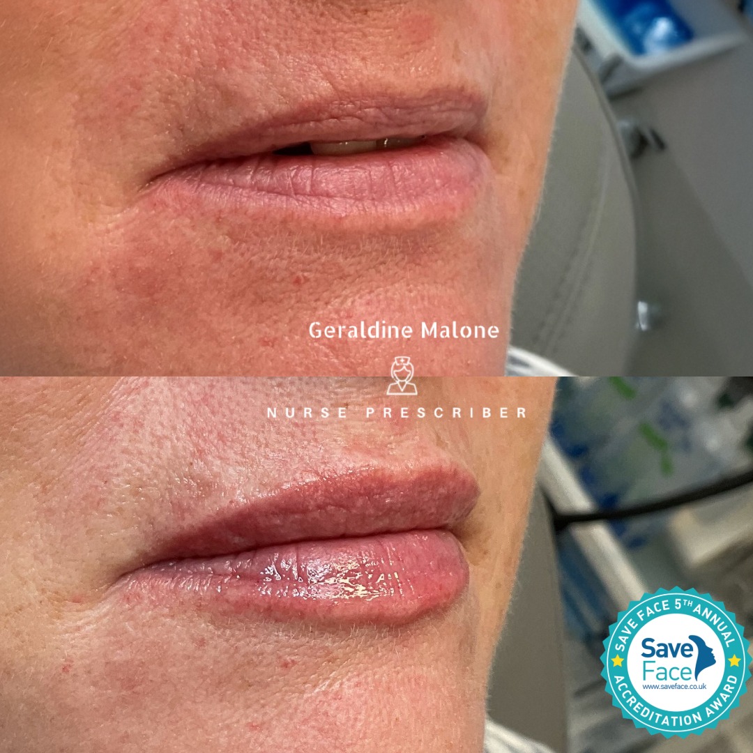 š 0.5ml Lip Enhancement Treatment
Enhance your natural beauty with soft hydration and refined volume ā tailored to maintain your unique shape and proportions.
-š Treatment price - 0.5ml -Ā£145/1ml -Ā£225
-ā± Recovery: 24ā48 hours
- Longevity: 6ā12 months
-NO edited images
All treatments are carried out by Nurse Prescriber Geraldine Malone within a Save Face Registered Clinic, ensuring the highest standards of safety and care.
š
Book your appointment here:
šhttps://www.geraldinemalone.co.uk/book-appointment
š Contact
āļø 024 7792 1812
š§ geraldinemaloneaesthetics@outlook.com