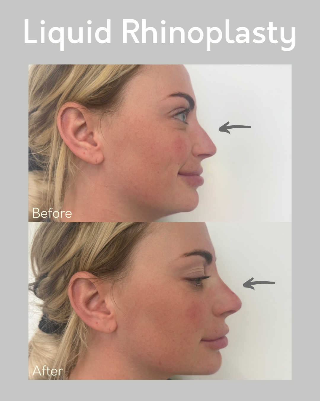 ✨ Non-surgical confidence boost! ✨
Check out this stunning before & after of a liquid rhinoplasty. With just a few precise filler injections, we refined the profile, smoothed bumps, and enhanced balance—all without surgery or downtime.
💉 Results are instant
⏱️ Minimal downtime
🌟 Natural, beautiful enhancement
Ready to love your side profile? Book your consultation today!
📞 513-469-0300
🌐 www.CincinnatiPlasticSurgery.com
#LiquidRhinoplasty #NonSurgicalNoseJob #CincinnatiPlasticSurgery #beforeandafter #PlasticSurgery #Medspa #CincinnatiAesthetics