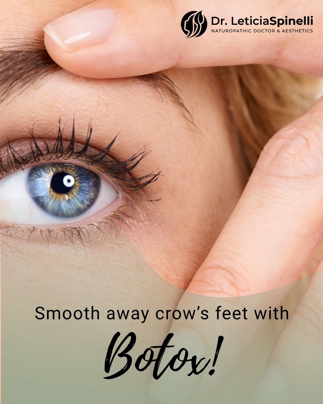 Smooth away crow’s feet with Botox!
Quick, effective, and minimally invasive. Botox relaxes the muscles around your eyes, reducing fine lines and giving you a refreshed, youthful look.
Because every smile deserves smooth, radiant skin.
Book your appointment with Dr. Leticia Spinelli today and take the first step toward your best skin!
#DrLeticiaSpinelli #Botox #CrowFeet #YouthfulEyes #SmoothSkin #ConfidenceBoost #AestheticCare