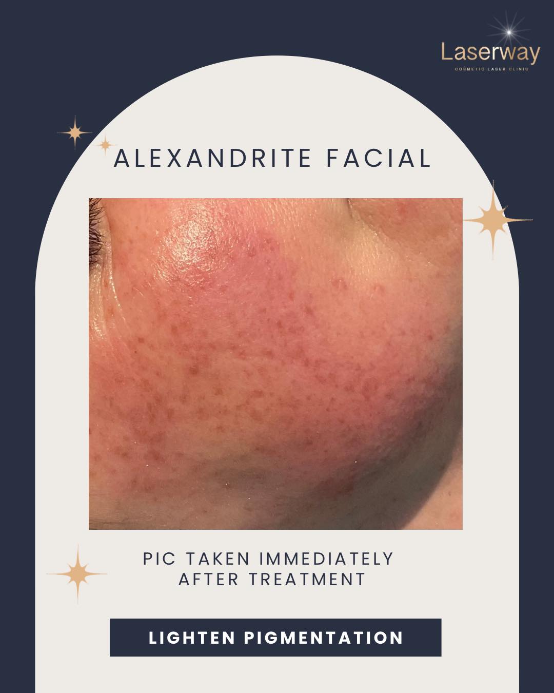 ✨ Now is the perfect season to tackle pigmentation! ✨
Our Alexandrite Facial is ideal for treating stubborn pigmentation, sun damage, and uneven skin tone – and autumn is the best time to start 🍂
We use the Candela Alexandrite 755nm laser, a gold standard in pigment reduction, to safely and effectively break down unwanted pigment
💎 Full face - £90
What to expect:
✔️ Mild redness post-treatment, which typically settles within a few hours
✔️ Pigment will darken over the next few days
✔️ Treated pigment will gradually slough off over the next week or so, revealing brighter, more even skin
📆 For best results, we recommend 3 sessions spaced 4–6 weeks apart.
We also offer Intense Pulsed Light (IPL) treatments for those with multiple concerns like redness, pigmentation, and uneven texture.
🌟 Not sure which treatment is right for you?
Book a free skin consultation, and we’ll recommend the perfect plan tailored to your skin needs.
📲 DM to book or ask us any questions!
#CandelaLaser #AlexandriteFacial #PigmentationRemoval #IPL #LaserFacial #GlowingSkin #SkinClinic #AutumnSkinCare #EvenSkinTone #ClearSkinJourney