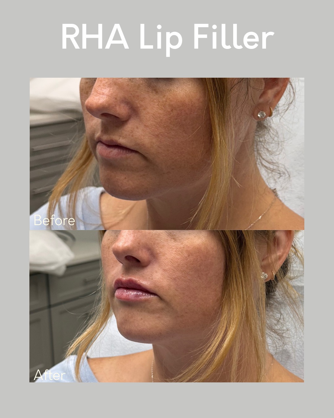 💋 Enhance your natural beauty with perfectly balanced lips! 💉✨
Our lip filler treatments are designed to add volume, define your shape, and smooth fine lines — leaving you with a soft, natural-looking pout you’ll love.
Swipe to see this gorgeous before & after transformation ➡️
Ready for your own glow-up? Book your lip filler appointment today at Cincinnati Plastic Surgery 💕
📞 513-469-0300
🌐 www.CincinnatiPlasticSurgery.com
#LipFiller #BeforeAndAfter #CincinnatiPlasticSurgery #NaturalResults #KissableLips #LipGoals #CincinnatiMedSpa #PlasticSurgery #Medspa #CincinnatiAesthetics