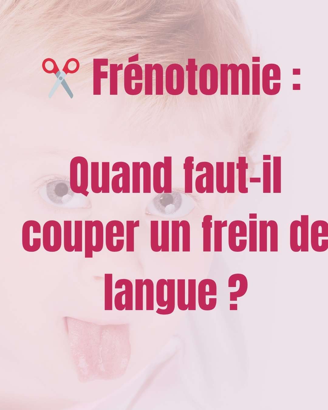 ✂️ Frénotomie : nécessaire ou précipitée ?
Le débat est ouvert… mais une chose est sûre : tous les freins visibles ne nécessitent pas d’intervention.
💡 Avant d’envisager une frénotomie, il faut une évaluation rigoureuse :
👉 gêne à la succion
👉 douleurs à l’allaitement malgré un bon accompagnement
👉 retentissement sur la croissance, les fonctions orales
📚 Certaines études montrent des bénéfices rapides… mais le geste seul ne suffit pas : il faut une vraie prise en charge globale.
👉 Dans le prochain post : que faire après une frénotomie pour éviter les récidives ?
#kinepediatrique #allaitement #lactation #SantéMamanBébé #ostéopathe974 #consultationallaitement #parentalite #reflux #saintpierre974 #freinlingual #osteopathiepediatrique
#freindelangue #ankyloglossie #freinlingual #freinrestrictif #freinbebe #freinoral #freinpostérieur #phrénotomie #kineperinatale #kinepediatrique