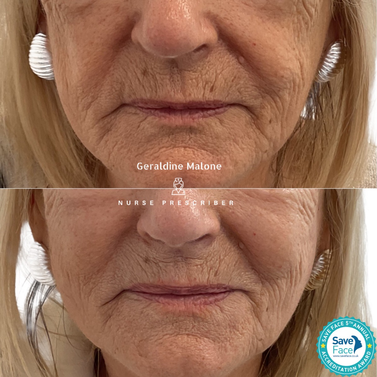 ✨ Profhilo Structura & Cheek Enhancement ✨
Restore hydration, improve skin quality, and subtly lift with a combination of Profhilo Structura and a small amount of cheek filler — designed to refresh while maintaining your natural appearance.
💉 Treatment: Profhilo Structura & Cheek Enhancement
⏱ Recovery: 24–48 hours
⏳ Longevity: 6–12 months
📸 NO edited images
All treatments are carried out by Nurse Prescriber Geraldine Malone within a Save Face Registered Clinic, ensuring the highest standards of safety and care.
📅 Book your appointment here:
👉 www.geraldinemalone.co.uk/book-appointment
📞 Contact
☎️ 024 7792 1812
📧 geraldinemaloneaesthetics@outlook.com