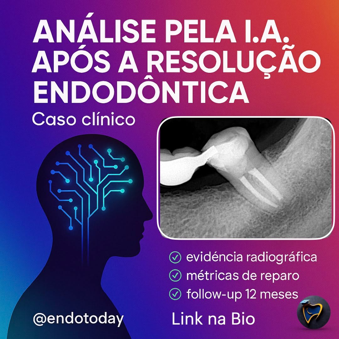 Análise pela IA após a resolução endodôntica (caso do post anterior) 🤖🦷
O tratamento foi concluído — e agora? No novo post do blog, mostro como a IA ajuda a documentar o reparo, medir evolução e padronizar o follow-up com rigor acadêmico.
Você vai ver no artigo:
• Comparação 0 → 12 meses: lâmina dura, trabeculado e área da radiolucidez
• Métricas objetivas (diâmetro/área) e laudo assistido por IA
• Critérios de sucesso radiográfico e quando indicar CBCT
• Limitações e como manter a decisão human-in-the-loop (ética + LGPD)
👉 Leia agora — link na bio
💬 Comente: qual métrica você usa no seu follow-up?
🔖 Salve e marque um colega que precisa revisar esses critérios.
#endodontia #odontologia #endodontics #dentista #dentistry #brasil #endolovers #odonto #endodontiamicroscopica #tratamentodecanal #endo #dentistas #saopaulo #sp #endodoncia #endodontic #dentist #endodontiabrasil #endodontiauberlândia #endodontiaportovelho #aorp74anos #dicasendodonticas #unaerp #ufu #unitri #faculdadepitágoras #uniube #uspribeirao #faculdadeestácio #uspribeirao
@ensinosahd @hdensinosoficial @aorp1946 @apcdararaquara
@thaischriscunha @chimenycurtiazzuz @pascoalinodoc @martinmeirelles @daniedison