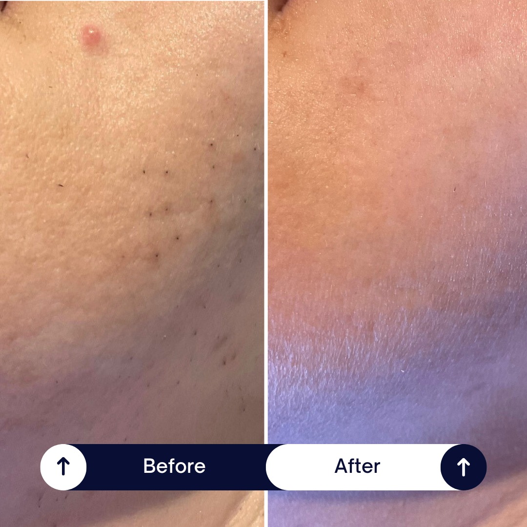 ✨ 𝗥𝗘𝗔𝗟 𝗥𝗘𝗦𝗨𝗟𝗧𝗦 | 𝗣𝗖𝗢𝗦 𝗧𝗥𝗔𝗡𝗦𝗙𝗢𝗥𝗠𝗔𝗧𝗜𝗢𝗡 ✨
Just look at the difference — and this is after only 𝗙𝗢𝗨𝗥 treatments! 😍
We're not finished yet, but the progress already speaks for itself 💥
This amazing client has 𝗣𝗖𝗢𝗦, and it’s proof that laser hair removal can work beautifully with the right plan.
Once the hair is reduced with your initial course, it can be kept 𝘀𝗺𝗼𝗼𝘁𝗵 𝗮𝗻𝗱 𝘂𝗻𝗱𝗲𝗿 𝗰𝗼𝗻𝘁𝗿𝗼𝗹 𝗹𝗼𝗻𝗴-𝘁𝗲𝗿𝗺 with 𝗿𝗲𝗴𝘂𝗹𝗮𝗿 𝘁𝗼𝗽-𝘂𝗽 𝘀𝗲𝘀𝘀𝗶𝗼𝗻𝘀.
✅ No more constant shaving
✅ No more irritation or razor bumps
✅ No more coarse, thick hairs
Laser really can be life-changing — especially for those dealing with hormonal hair growth.
💬 Book your 𝗙𝗥𝗘𝗘 𝗰𝗼𝗻𝘀𝘂𝗹𝘁𝗮𝘁𝗶𝗼𝗻 & 𝗽𝗮𝘁𝗰𝗵 𝘁𝗲𝘀𝘁 𝘁𝗼𝗱𝗮𝘆! This is the BEST time of year to start — you’ll even notice a difference after your patch test!
📅 DM us – smooth skin is just around the corner 💕
#PCOSAwareness #LaserHairRemoval #BeforeAndAfter #SmoothSkinJourney #HairFreeConfidence #NoMoreShaving #PCOSsupport #LaserResults #PatchTestReady #SkinGoals