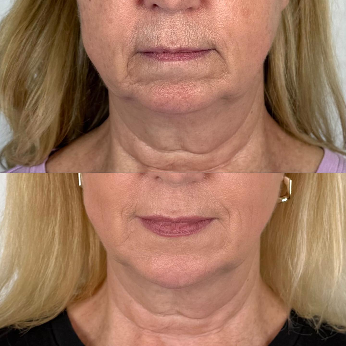 Slow and steady ✨
This transformation didn’t happen overnight — it was achieved through a thoughtful, step-by-step approach over multiple sessions, including strategic dermal filler injections and our TSS (Total Skin Solution) — a powerful combination of RF microneedling and Ultra Laser resurfacing for collagen stimulation, firming, and skin renewal.
Small, intentional refinements that quietly transform the entire profile, restoring balance, symmetry, and projection through the chin and lower face.
Scroll to see additional angles ➡️
Our goal is always natural harmony. The ultimate outcome? Restoring confidence and helping our patients feel more like themselves again. 🤍
We’re so grateful to those who allow us to share their results and show what customized treatments and a skilled aesthetic eye can achieve — natural, balanced, confidence-boosting results.
#NaturalResults #FacialBalancing #ChinFiller #ProfileHarmony #LowerFaceRejuvenation #RFmicroneedling #UltraLaser #TotalSkinSolution #CollagenStimulation #DallasAesthetics #SubtleEnhancement #ArgyleInjector #fācaesthetics