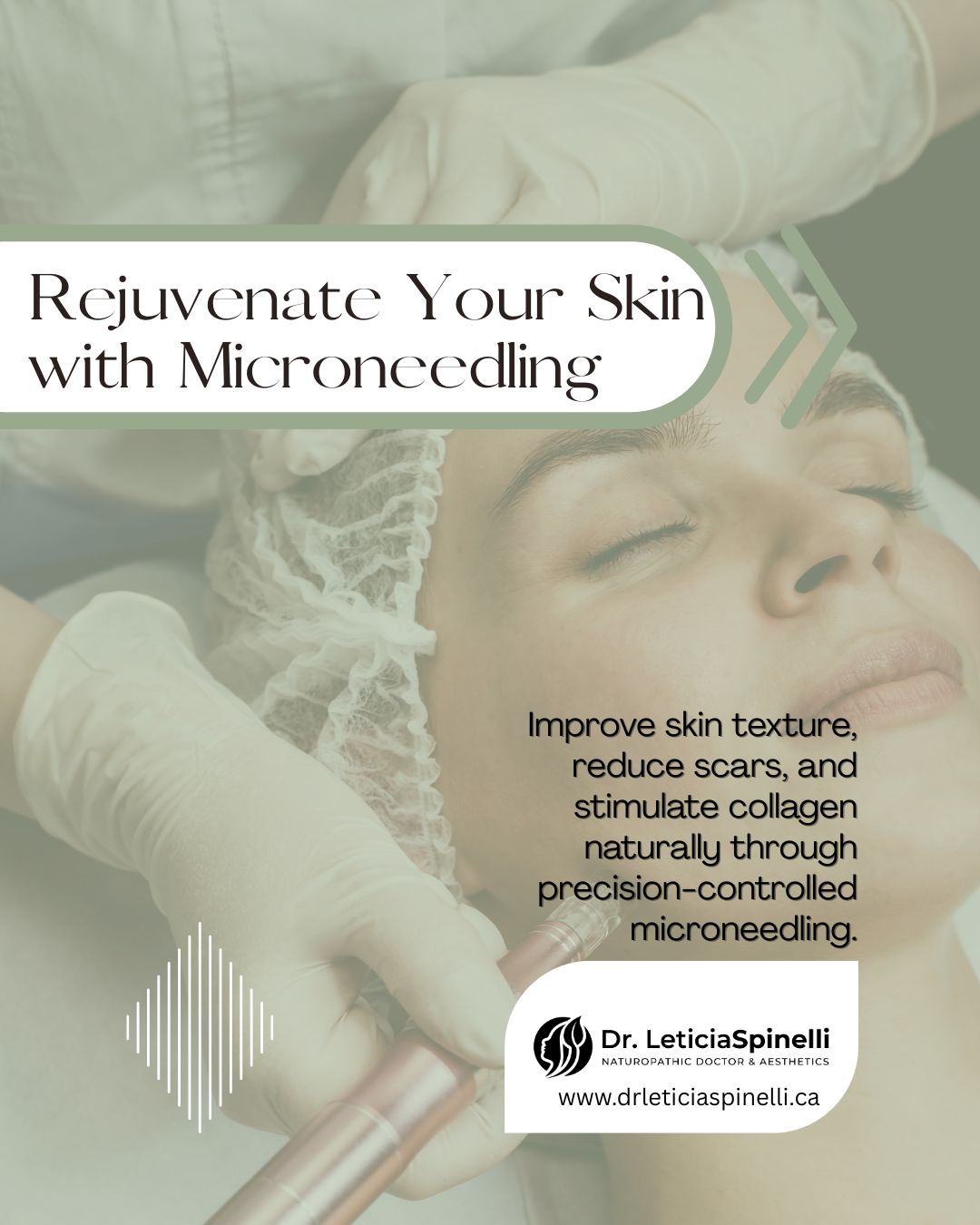 🌿 Rejuvenate Your Skin with Microneedling
It’s time to boost your glow from within!
Improve skin texture, reduce scars, and stimulate collagen naturally through precision-controlled microneedling.
Dr. Leticia Spinelli, ND, provides personalized treatments designed for natural, radiant results — because your skin deserves the best care.
📅 Book your Microneedling session today and start your journey to a refreshed, confident glow!
#RioSkinClinic #DrLeticiaSpinelli #Microneedling #HealthySkin #CollagenBoost #NaturalResults #SkinRejuvenation #AestheticCare #GlowFromWithin #ConfidenceInYourSkin