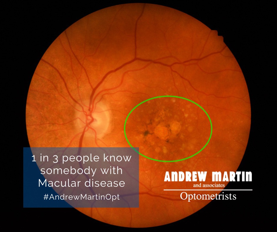 Did you know age-related macular degeneration is one of the UK’s leading causes of sight loss? Early detection makes a big difference. Over 60s are entitled to free NHS eye tests - book yours today.
#AndrewMartinOpt #HealthyAgeing #SightCareLocal #SuttonColdfield #Boldmere #MereGreen