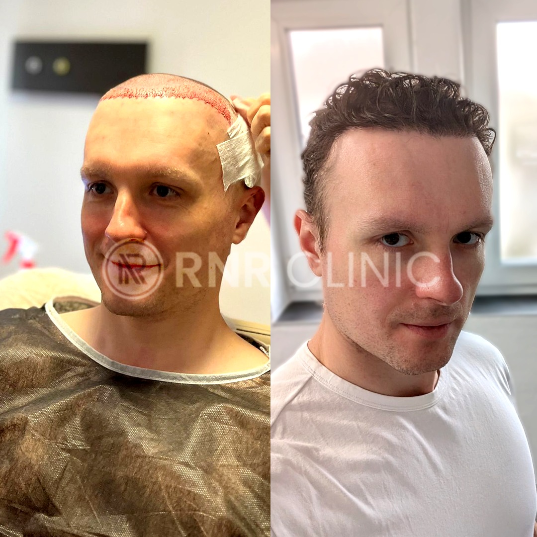 ✨ Echte Veränderung, echtes Ergebnis! ✨
Eine natürliche Haarlinie, dichte und ästhetische Ergebnisse –
📍 Bei RNR CLINIC TURKEY wurde diese beeindruckende Haartransformation von unserem erfahrenen Team durchgeführt!
✅ Natürliche Haarlinie
✅ Maximale Graft-Anzahl
✅ Schmerzfreie und komfortable Behandlung
✅ Professionelle Nachsorge & 24/7 Betreuung
🌍 Für unsere internationalen Patienten inklusive Hotel & VIP-Transfer-Service.
Gewinne dein Selbstvertrauen zurück – mit deinem neuen Haarlook! 💪
📩 Schreib uns jetzt für eine kostenlose Beratung.
#rnrclinicturkey #haartransplantation #haartürkei #beforeafter #haarttransformation #istanbulclinic #hairrestoration #hairclinic