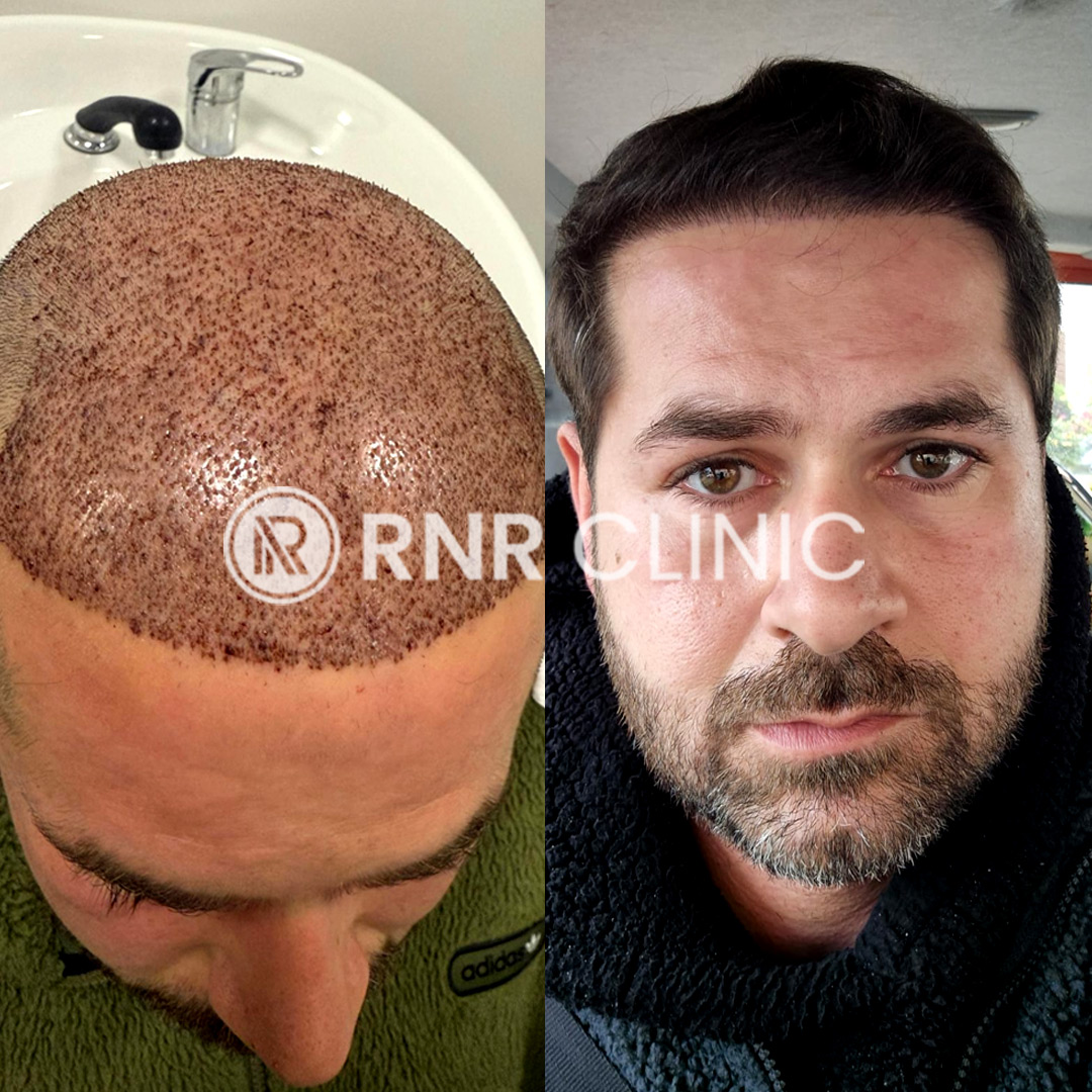 ✨ Echte Veränderung, echtes Ergebnis! ✨
Eine natürliche Haarlinie, dichte und ästhetische Ergebnisse –
📍 Bei RNR CLINIC TURKEY wurde diese beeindruckende Haartransformation von unserem erfahrenen Team durchgeführt!
✅ Natürliche Haarlinie
✅ Maximale Graft-Anzahl
✅ Schmerzfreie und komfortable Behandlung
✅ Professionelle Nachsorge & 24/7 Betreuung
🌍 Für unsere internationalen Patienten inklusive Hotel & VIP-Transfer-Service.
Gewinne dein Selbstvertrauen zurück – mit deinem neuen Haarlook! 💪
📩 Schreib uns jetzt für eine kostenlose Beratung.
#rnrclinicturkey #haartransplantation #haartürkei #beforeafter #haarttransformation #istanbulclinic #hairrestoration #hairclinic