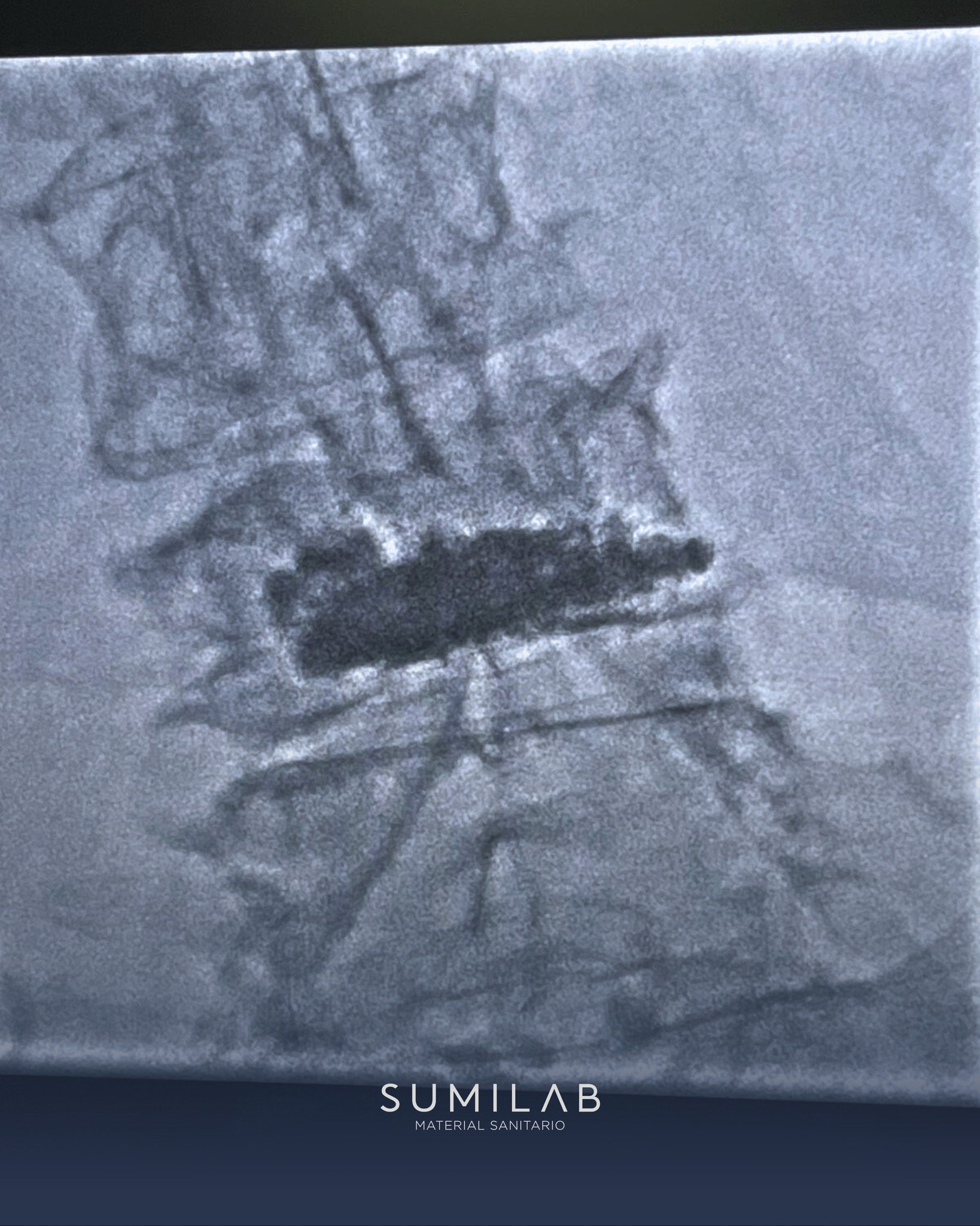 Paciente de 91 años tratada con éxito de una fractura osteoporótica vertebral en L4 💪
El procedimiento de cementación (vertebroplastia) fue realizado por el @dr.manuelcifrian en el Hospital General de Castellón, ofreciendo estabilidad, alivio del dolor y una recuperación más rápida.
Un claro ejemplo de cómo las técnicas intervencionistas mínimamente invasivas pueden mejorar significativamente la calidad de vida en pacientes de edad avanzada.